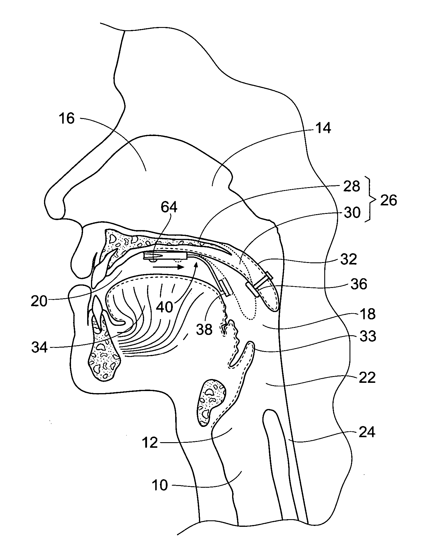 Systems and methods for moving and/or restraining tissue in the upper respiratory system