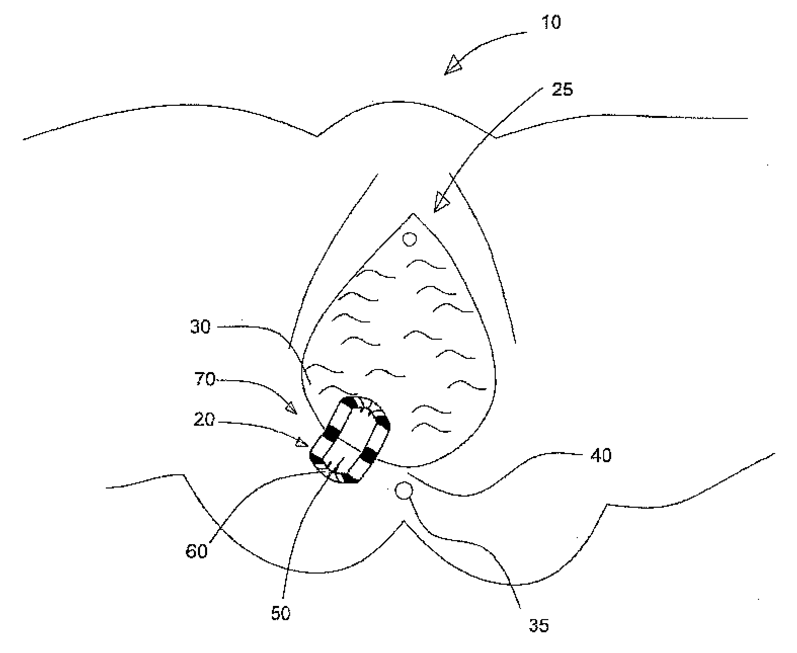 Episiotomy aid device