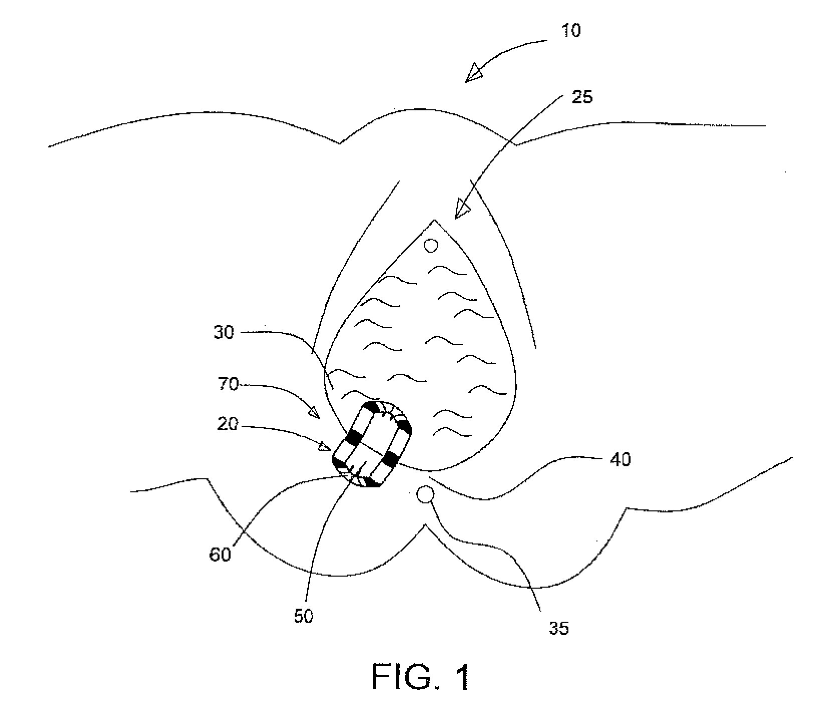 Episiotomy aid device