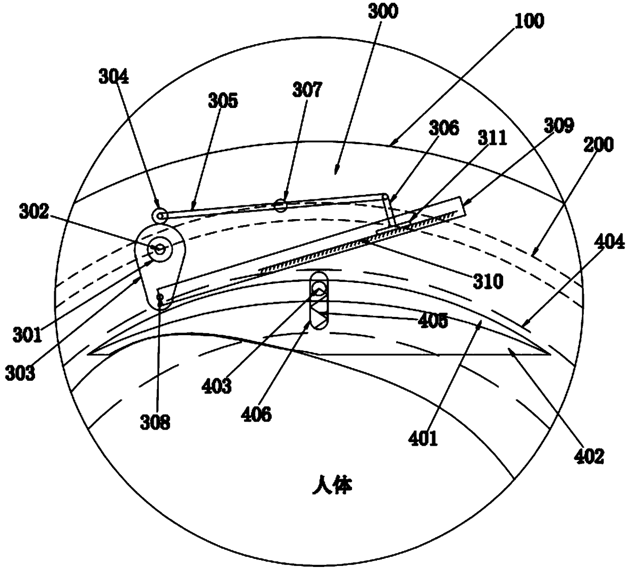 Internet intelligent massage orthopedic splint combining traditional Chinese medicine and western medicine