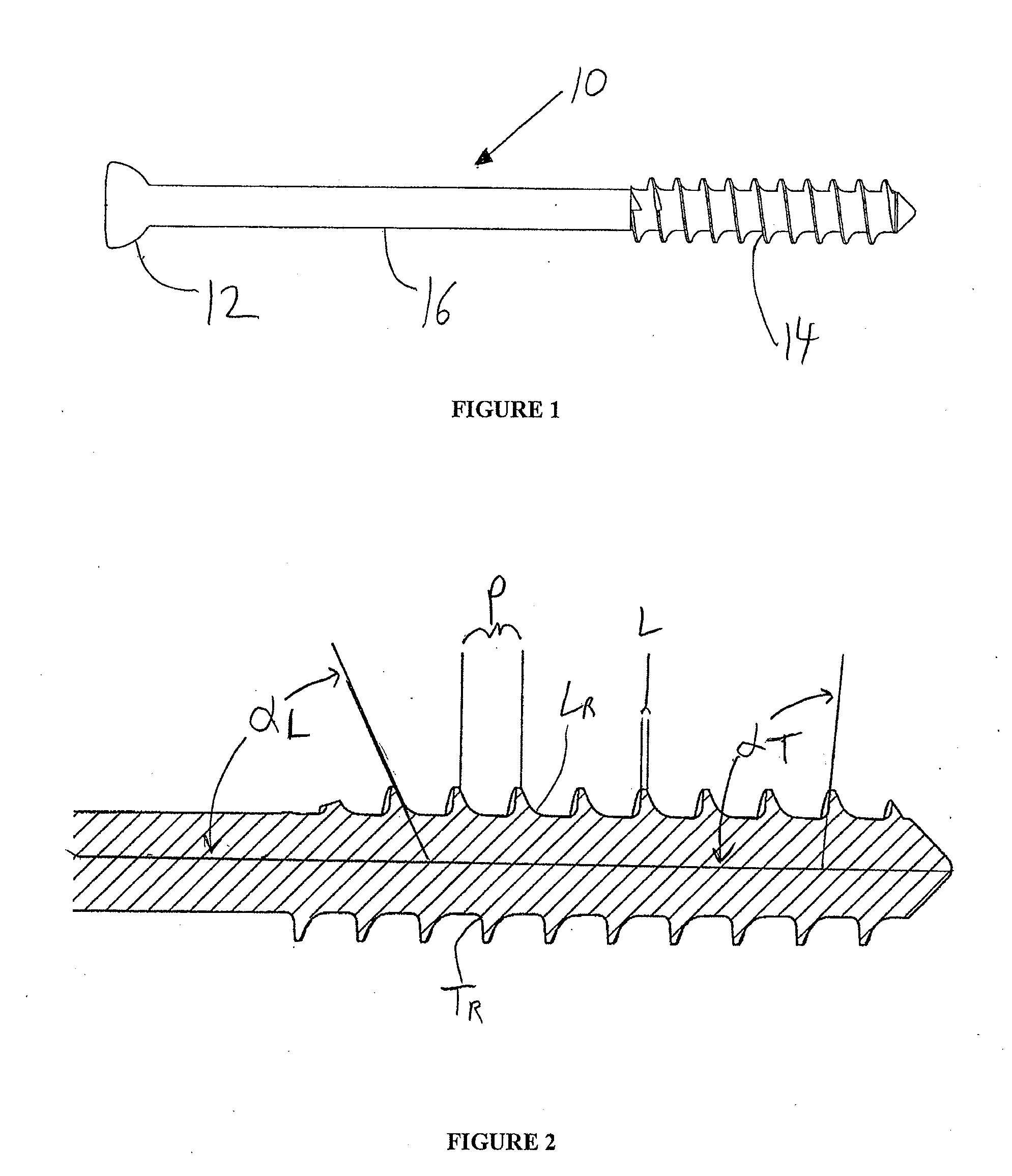 Bone Screw System