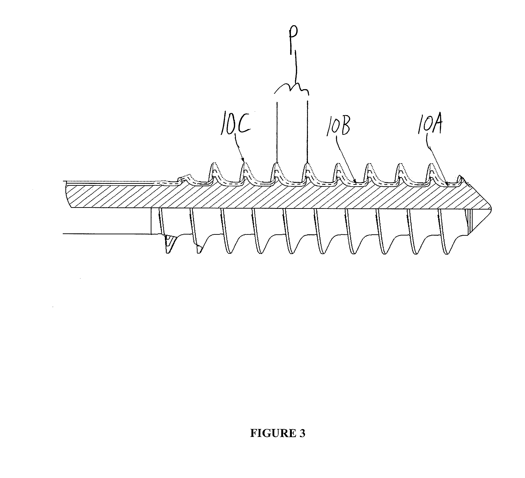 Bone Screw System