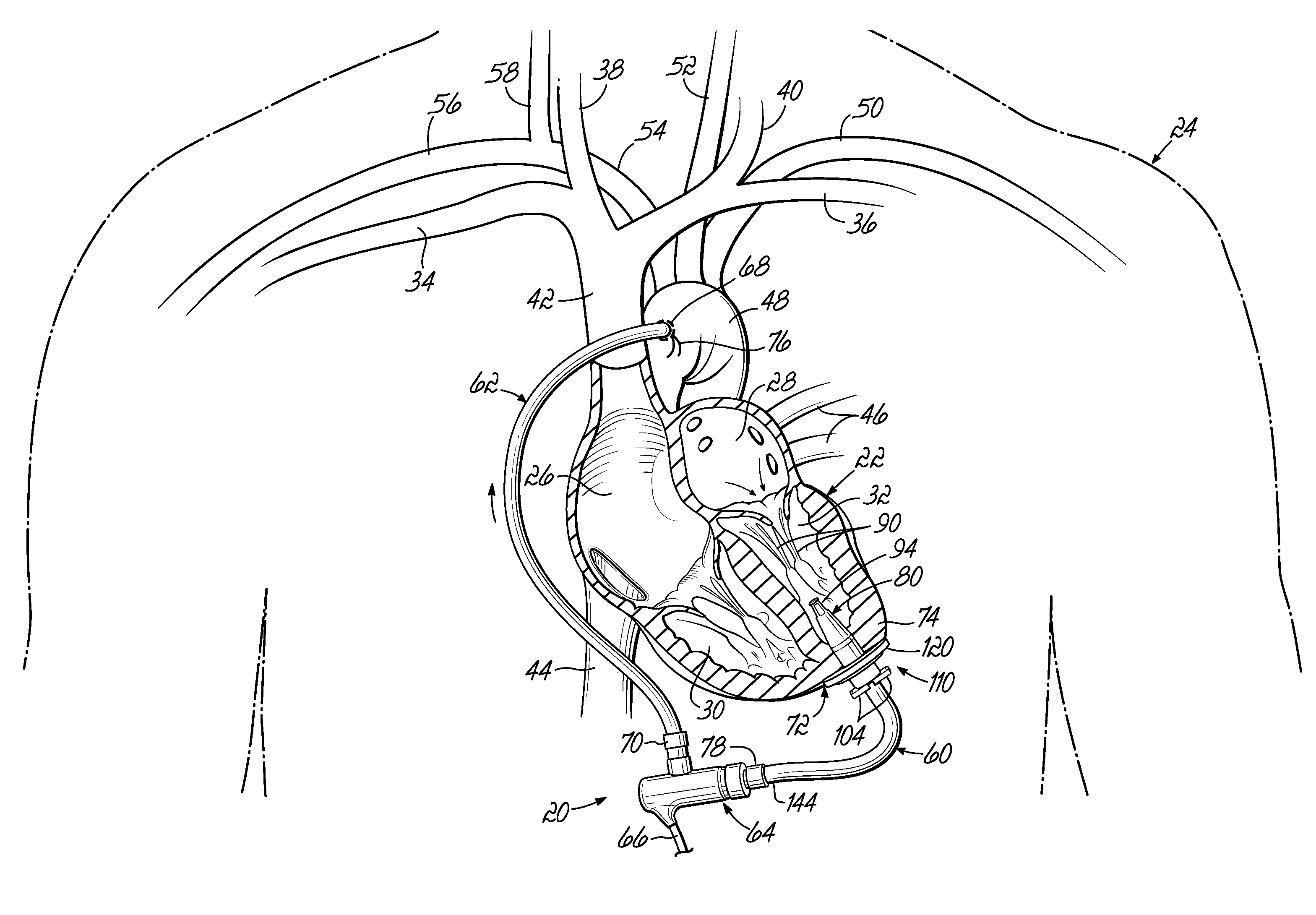 Cannula tips, tissue attachment rings, and methods of delivering and using the same