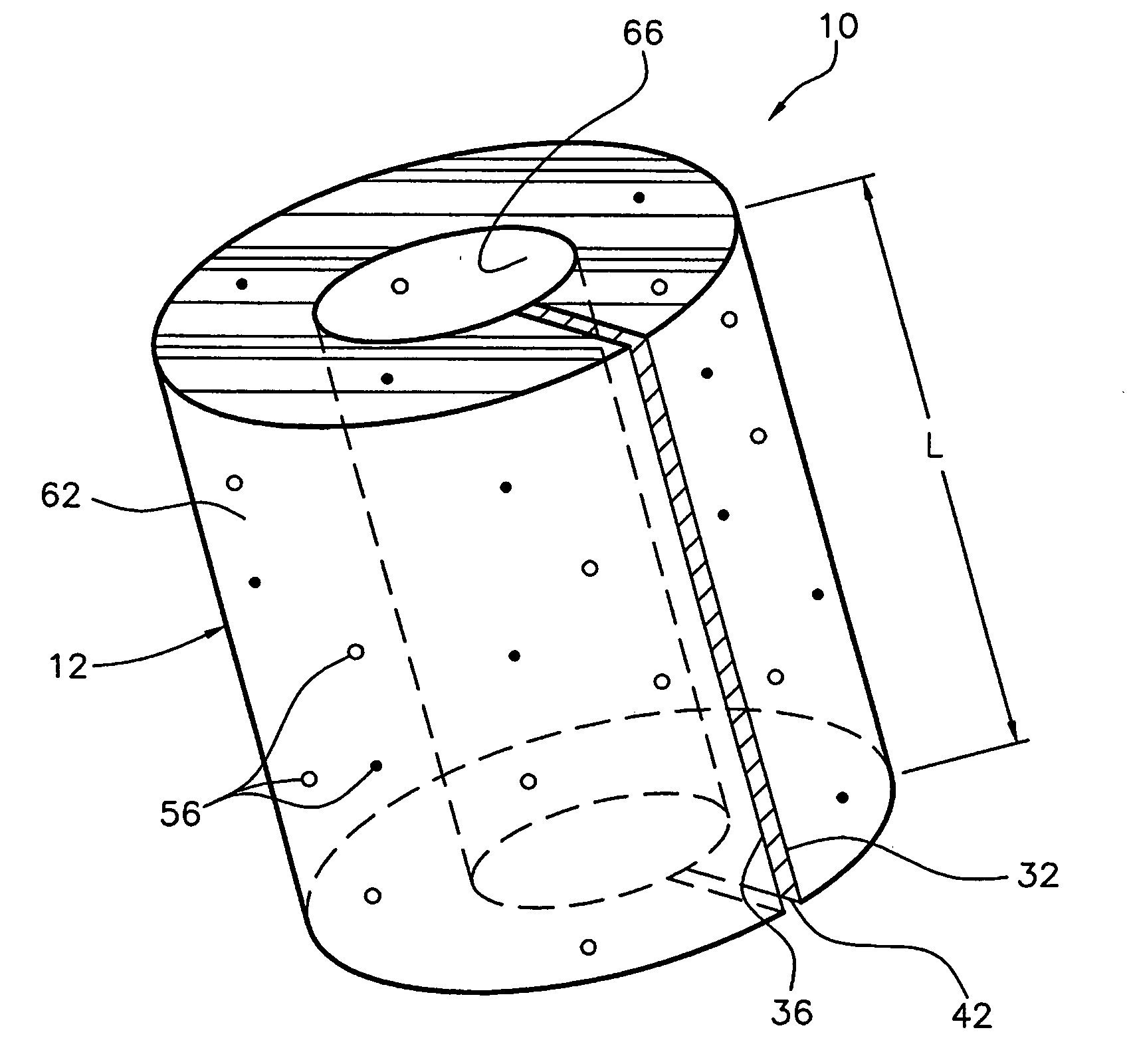 Local drug-delivery system