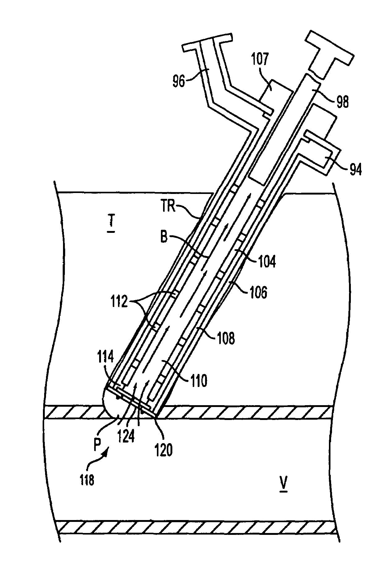 Autologous wound sealing apparatus