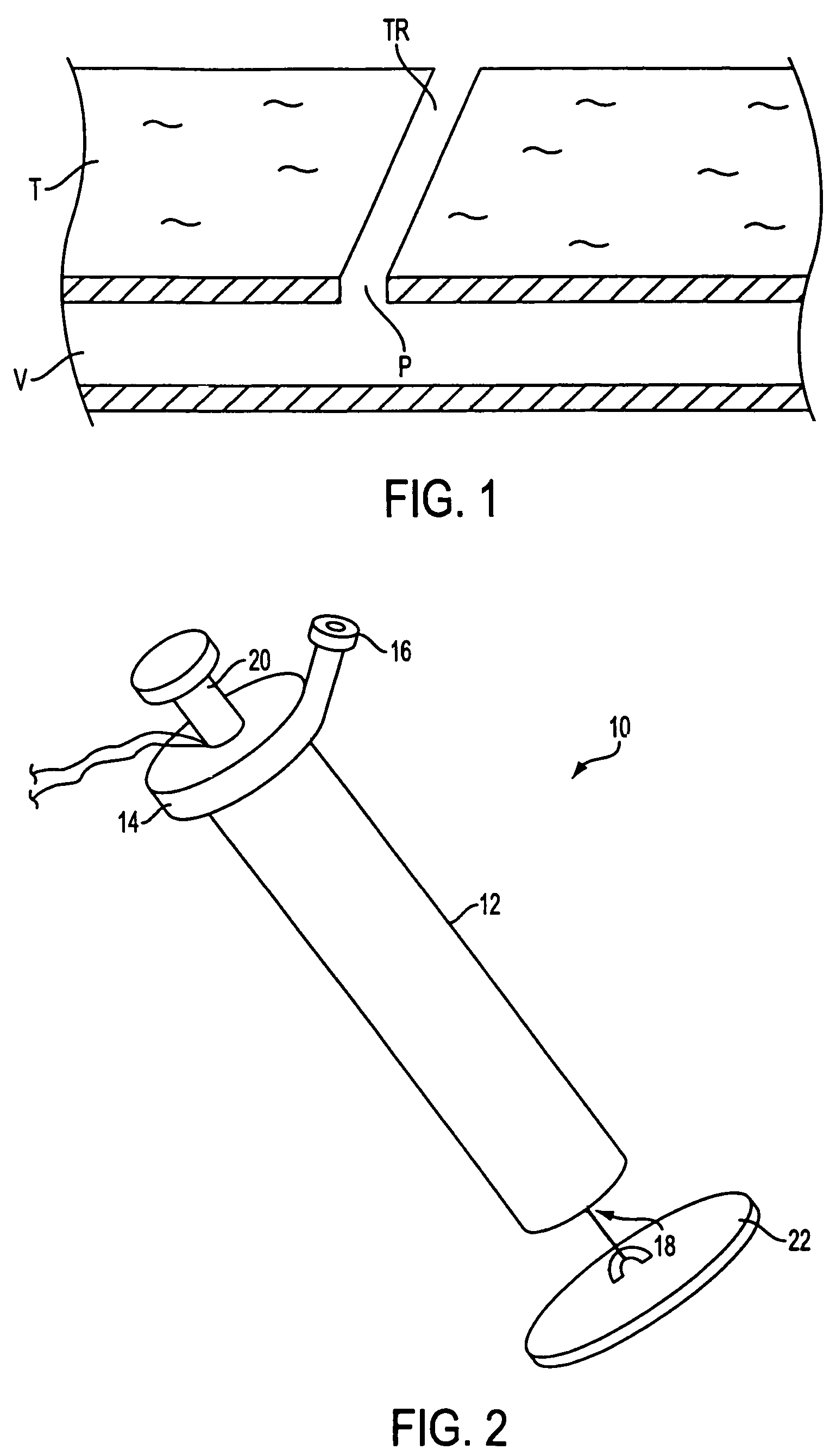 Autologous wound sealing apparatus