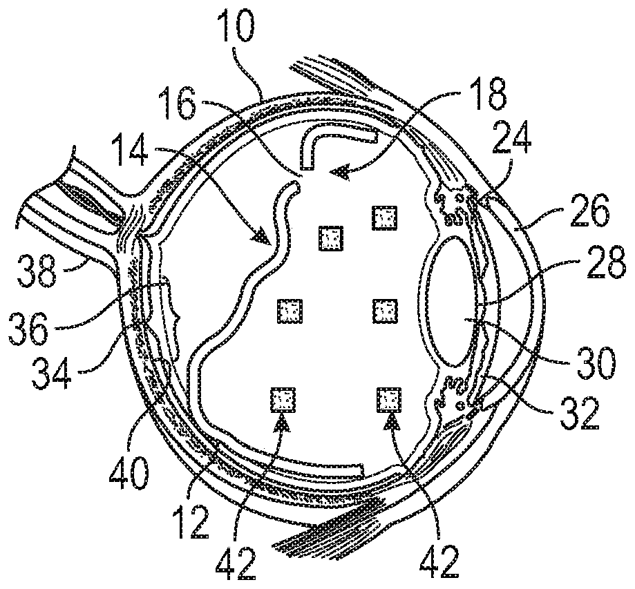 Methods and devices for treating a retinal detachment