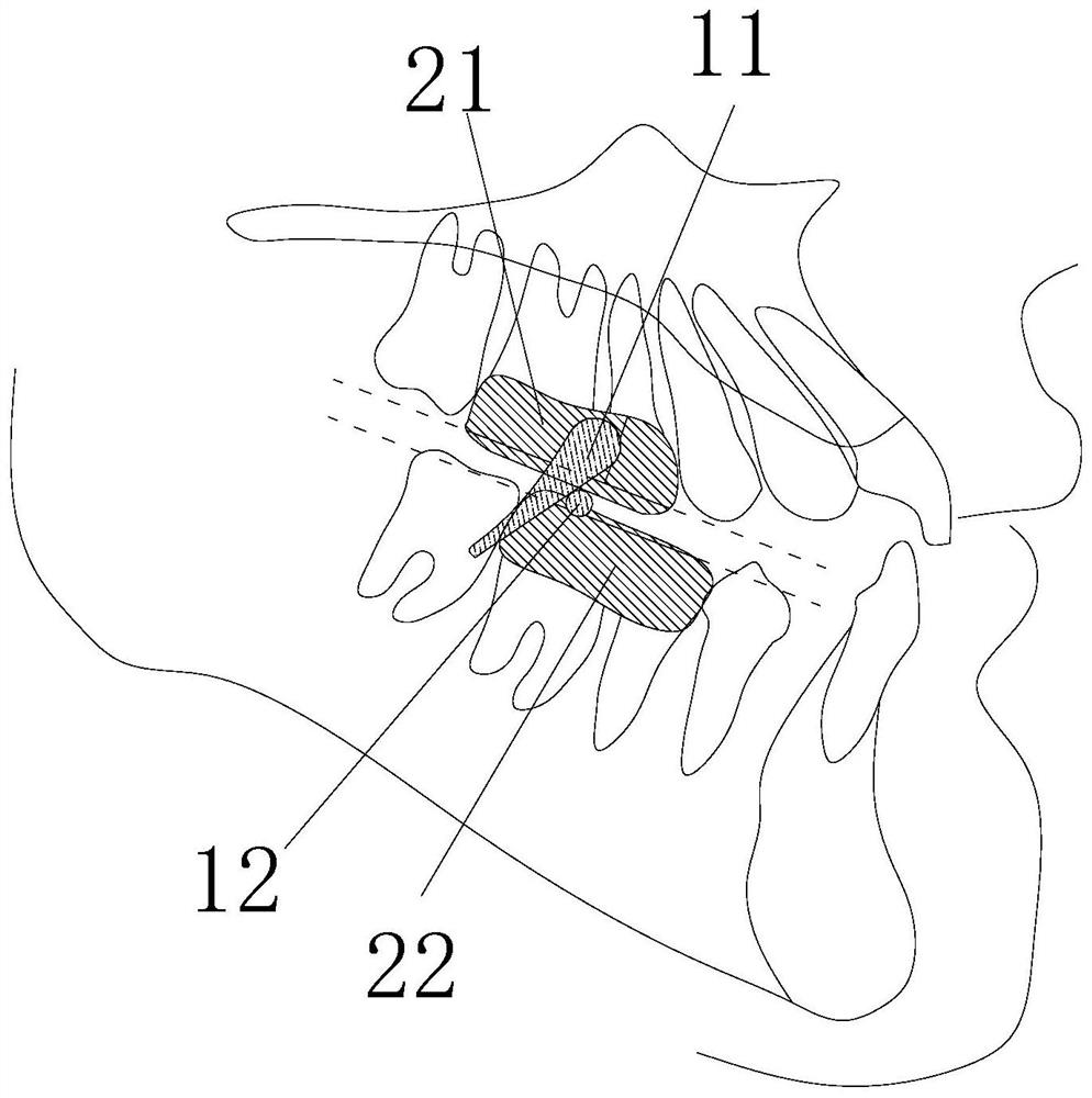 Forward mandibular positioning device for orthodontics