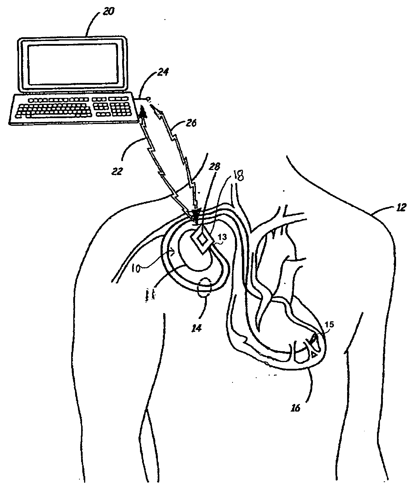 Implantable medical device with MRI and gradient field induced capture detection methods