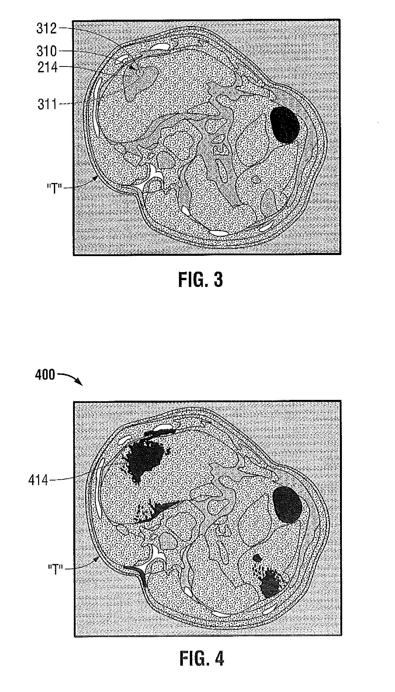 Methods for Image Analysis and Visualization of Medical Image Data Suitable for Use in Assessing Tissue Ablation and Systems and Methods for Controlling Tissue Ablation Using Same