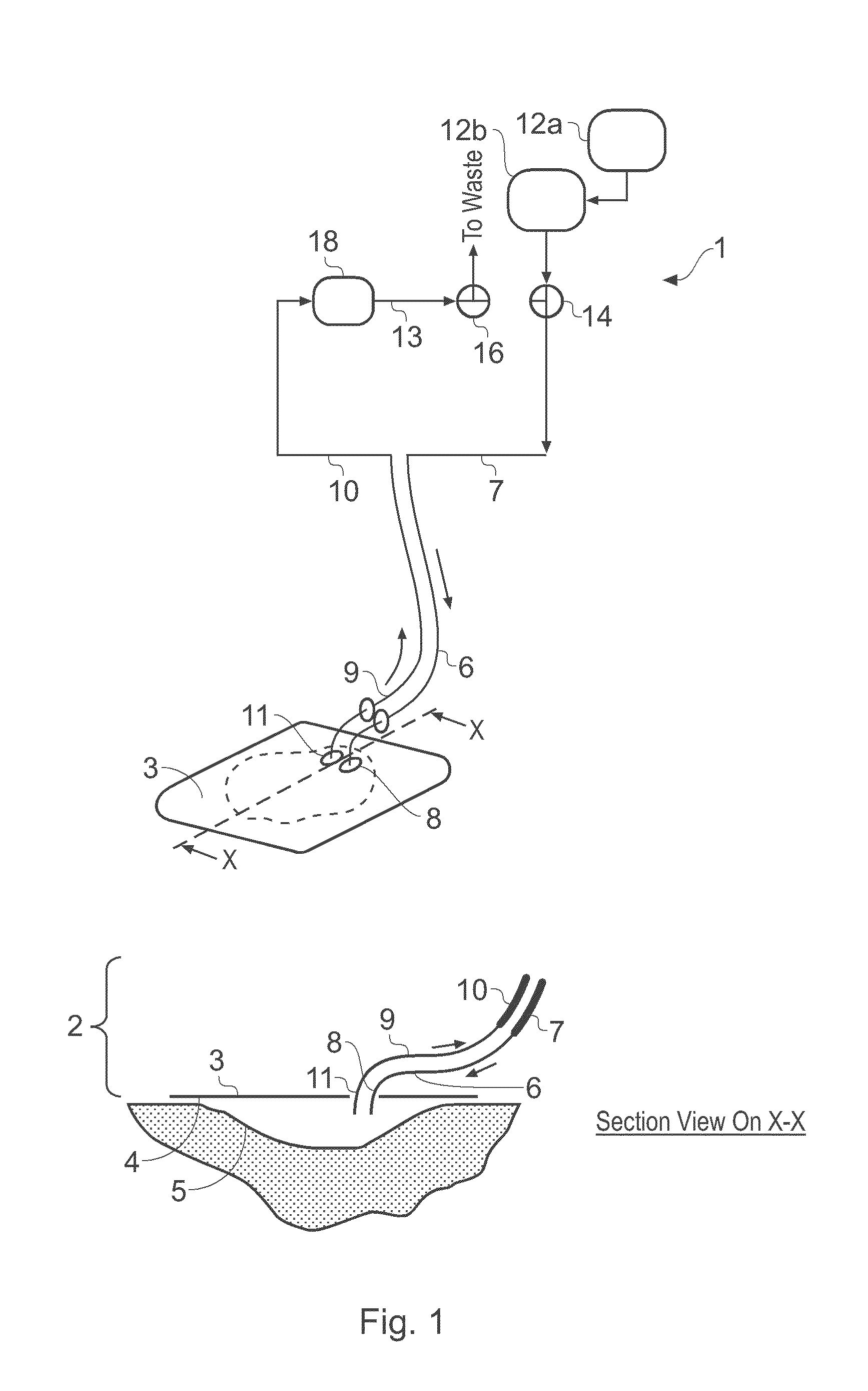 Wound treatment apparatus and method