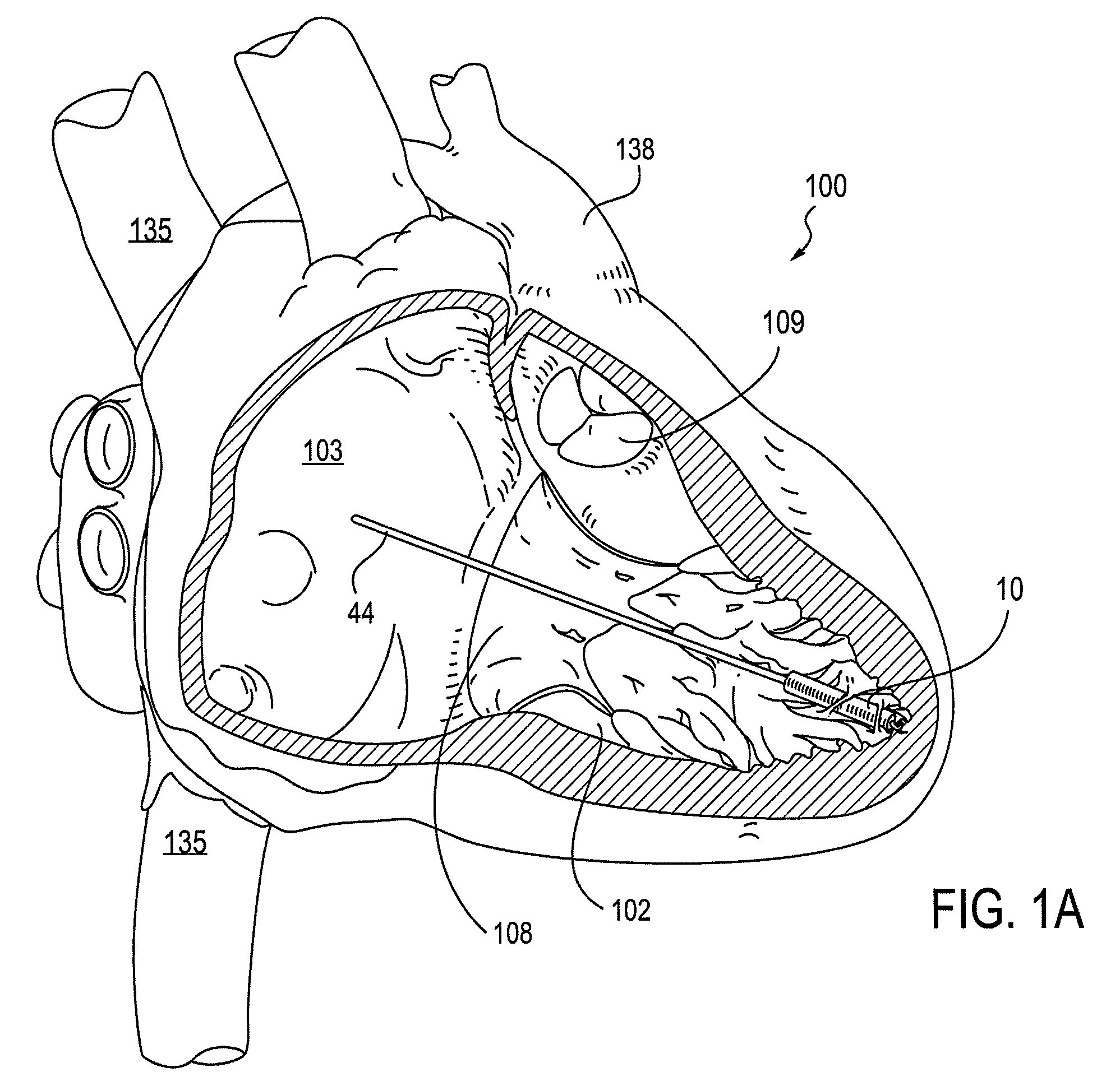 Leadless cardiac pacemaker with secondary fixation capability