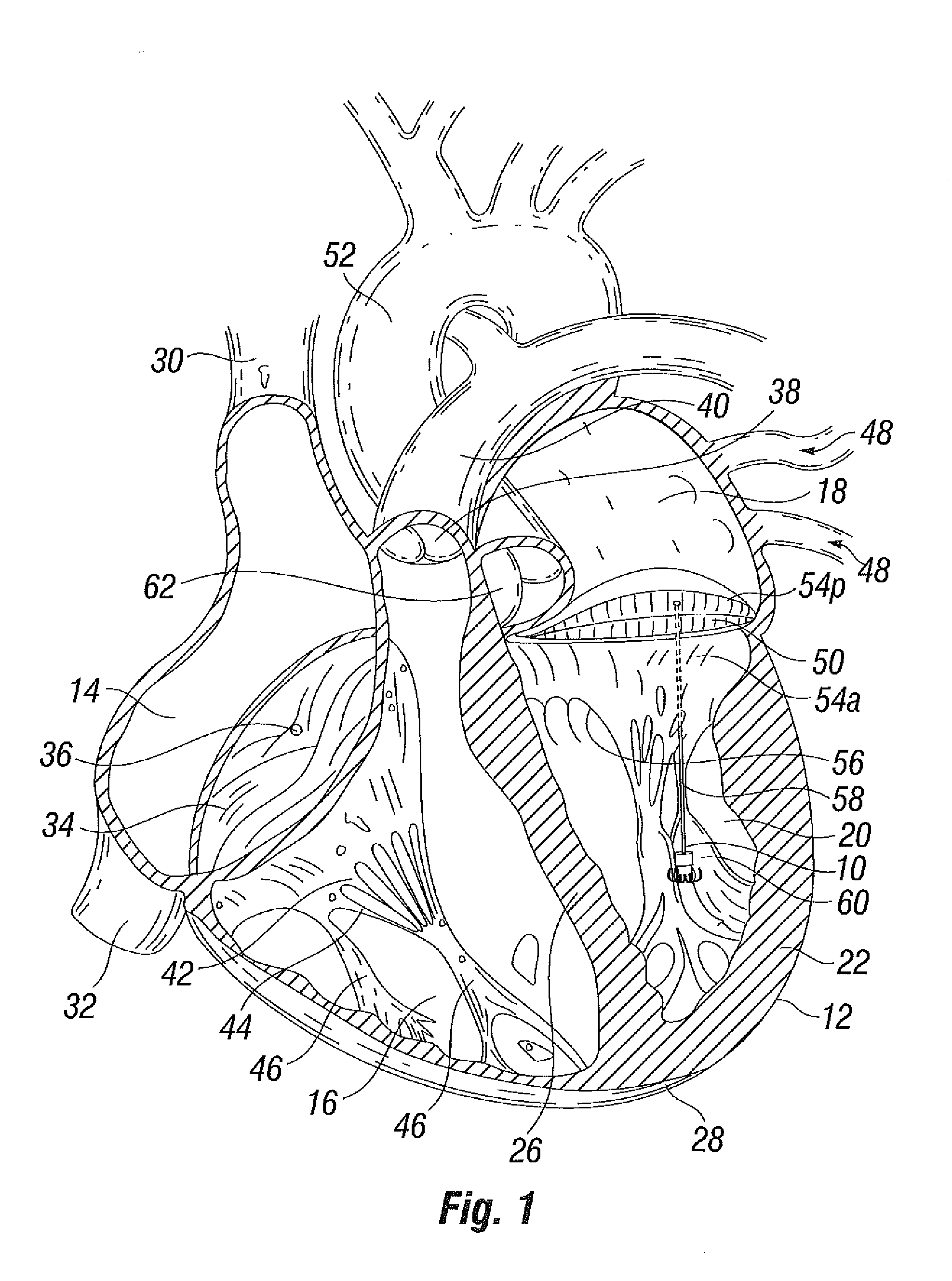 Suture and method for repairing a heart