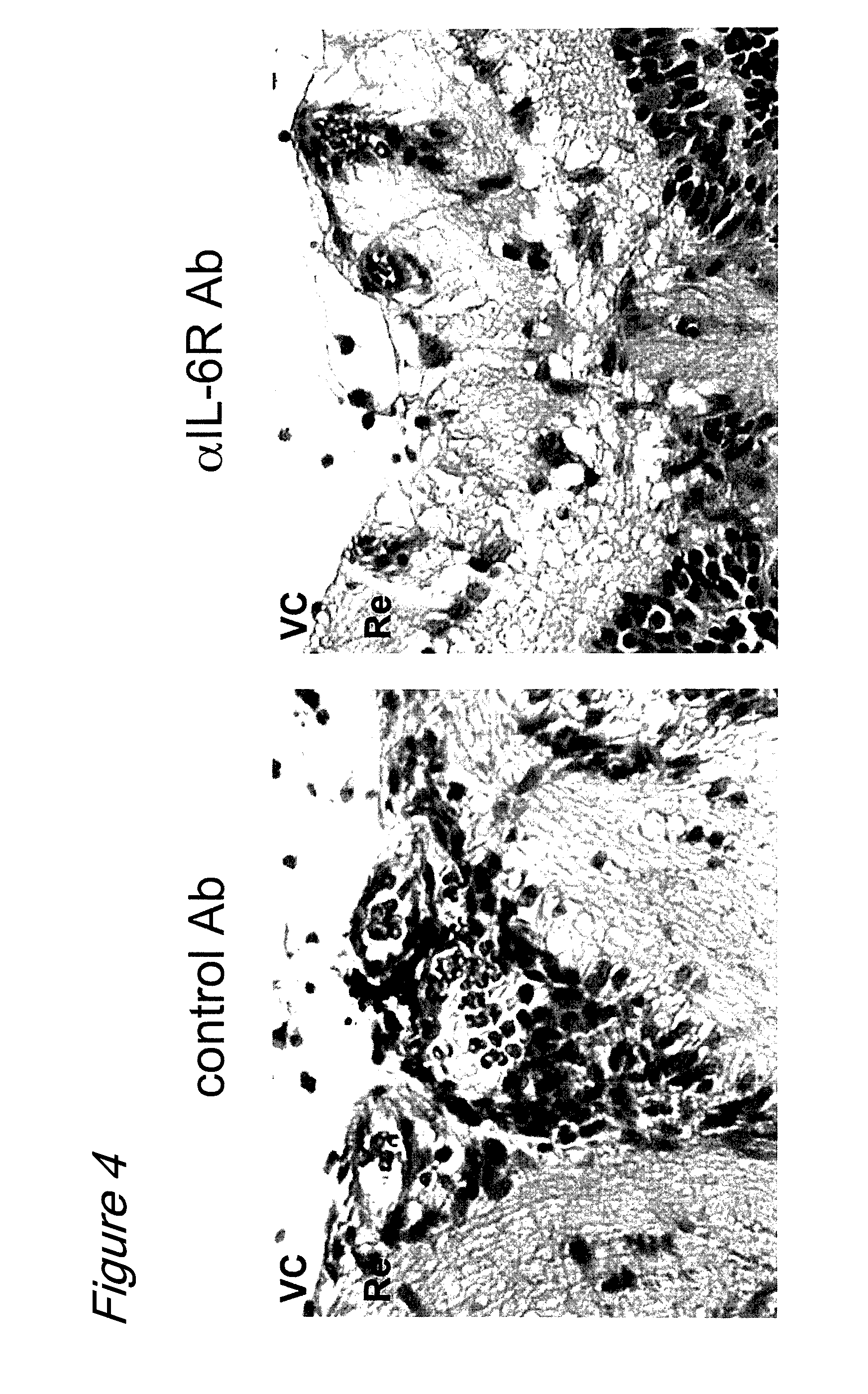 Therapeutic agents for ocular inflammatory disease comprising interleukin 6 receptor inhibitor as active ingredient