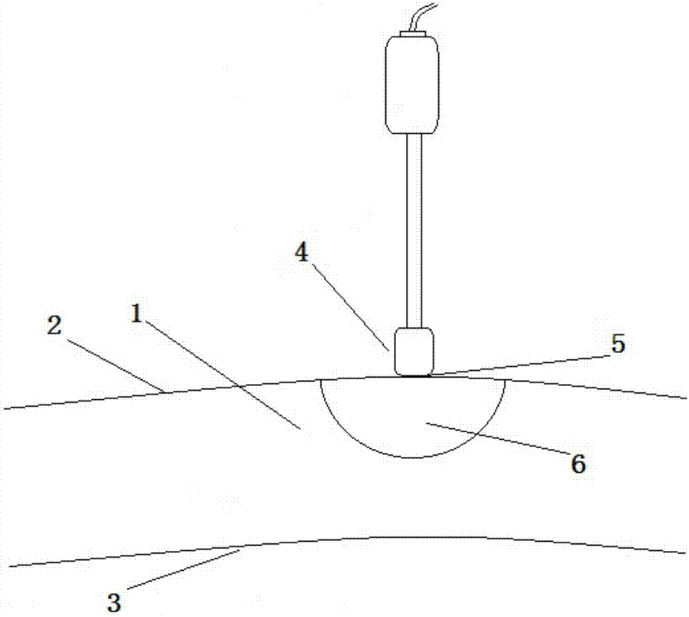 Myocardium ablation device