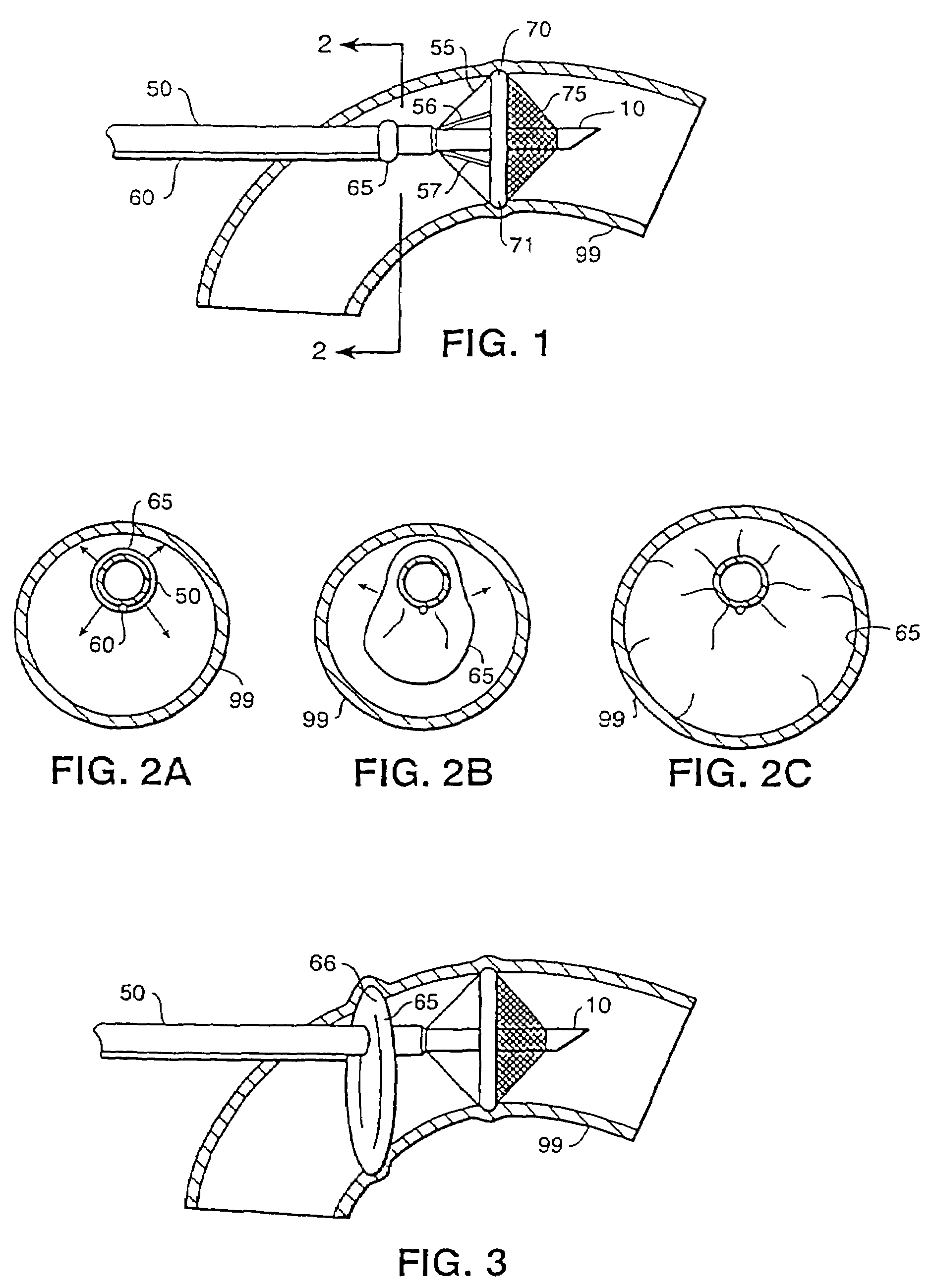 Aortic occluder with associated filter and methods of use during cardiac surgery