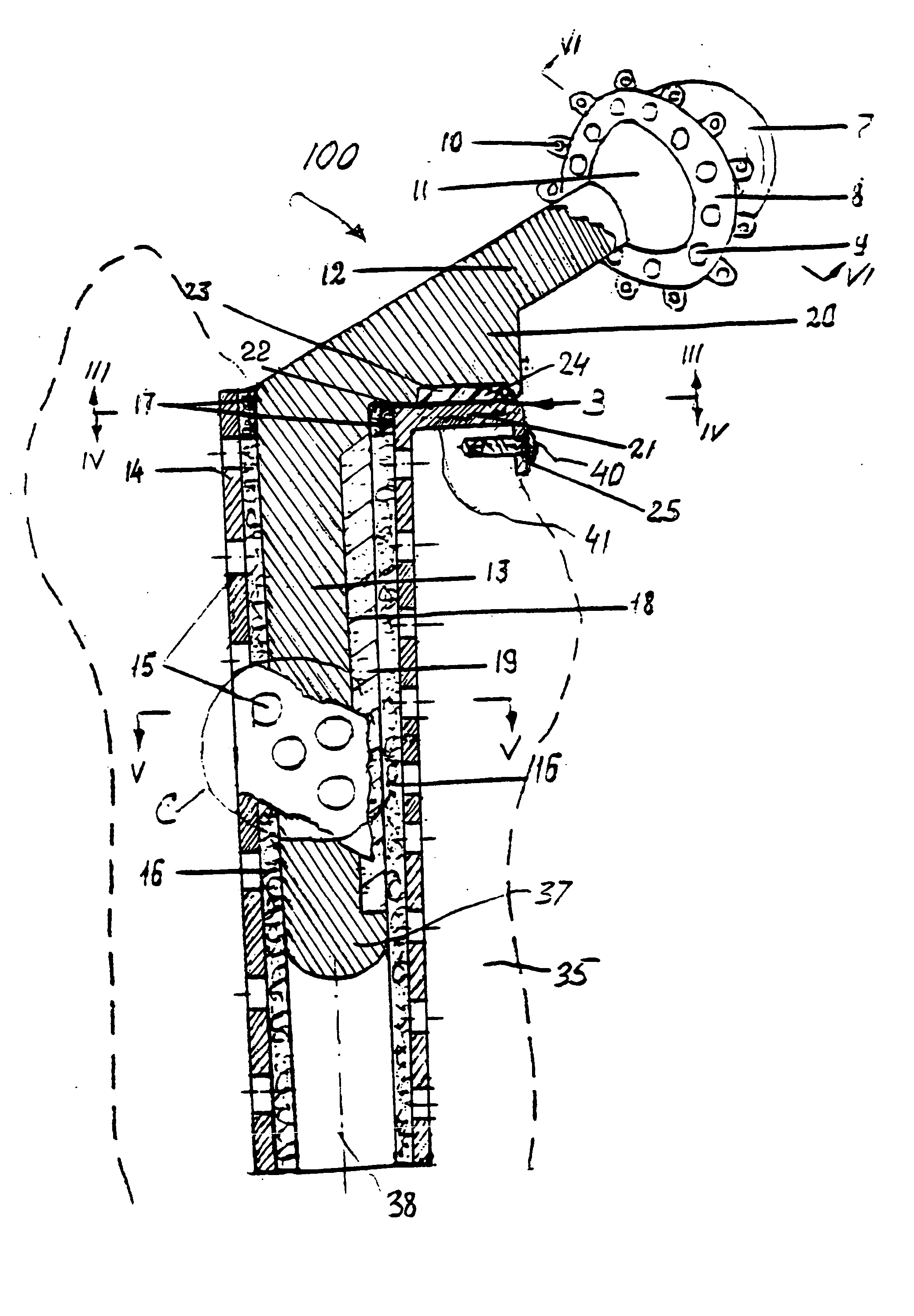 Hip prosthesis