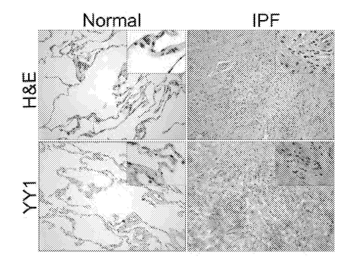 Methods of diagnosing and treating fibrosis