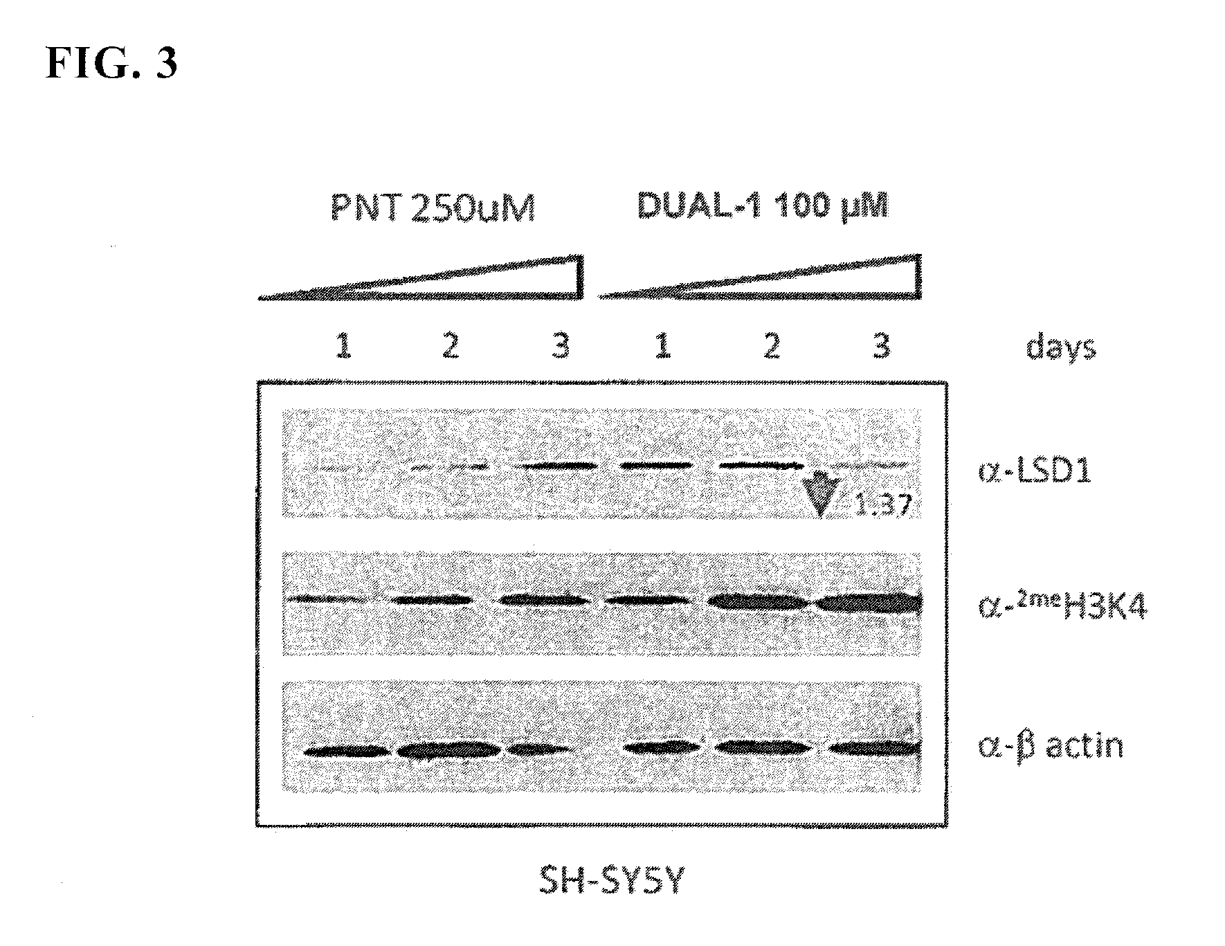 Lysine demethylase inhibitors for myeloproliferative or lymphoproliferative diseases or disorders