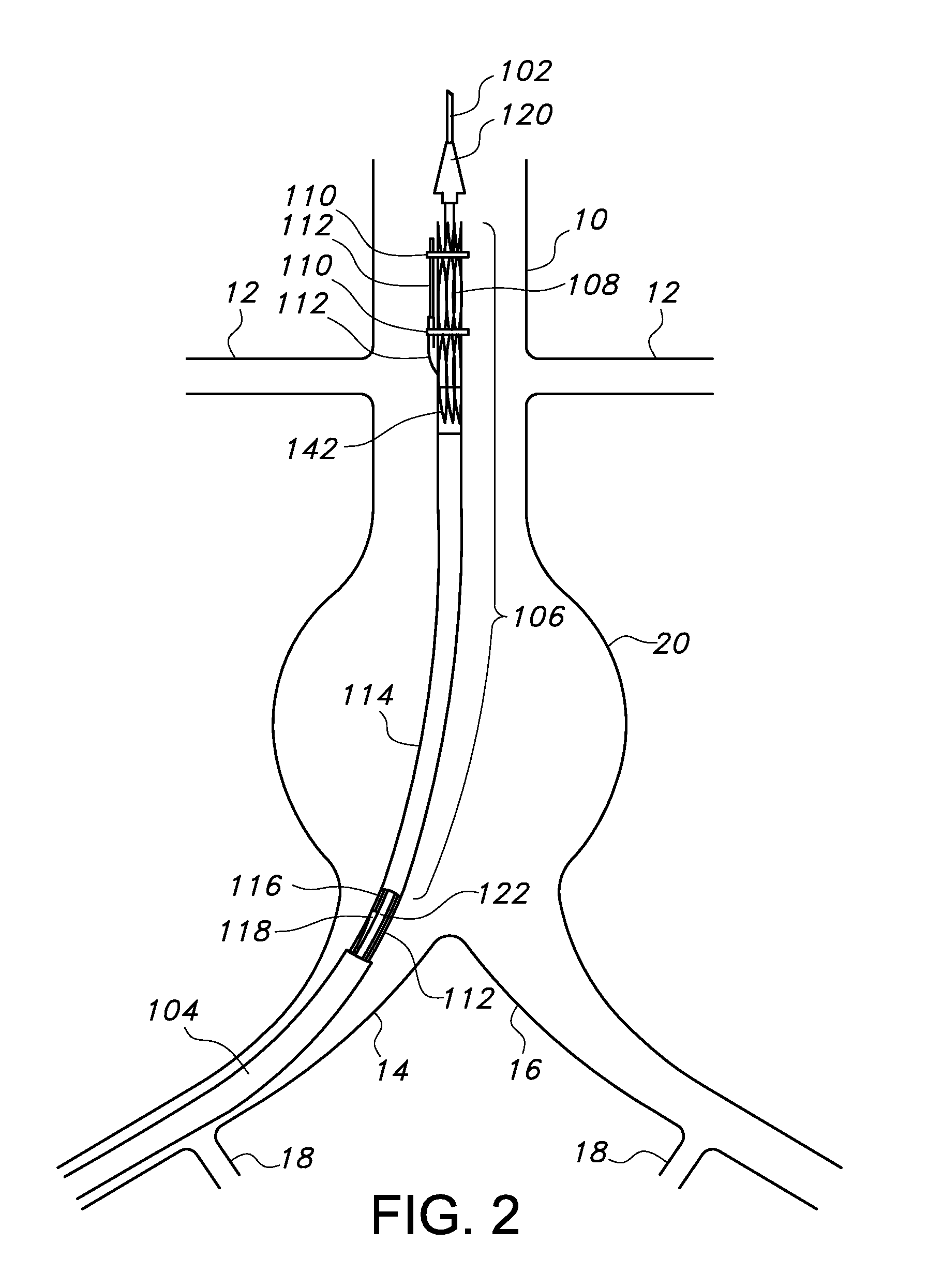 Bifurcated endovascular prosthesis having tethered contralateral leg