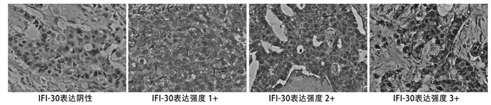 Application of protein/gene IFI30 related to occurrence and development of breast cancer