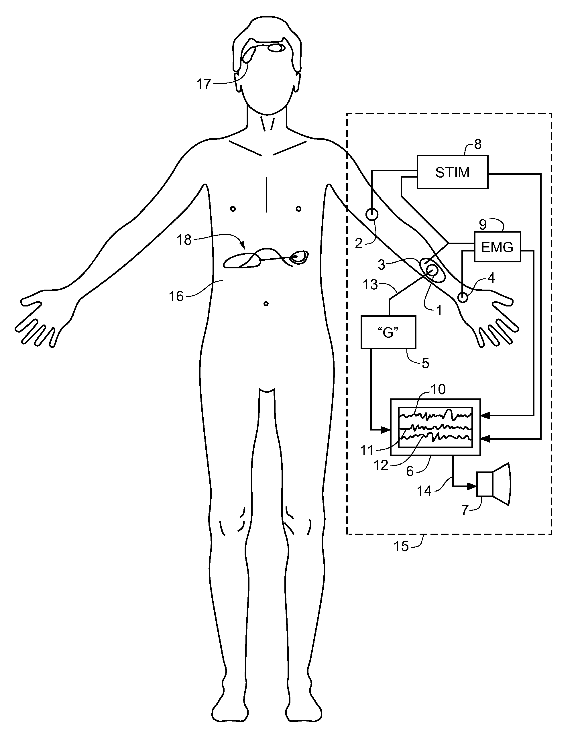 Anesthesia Monitoring Device and Method