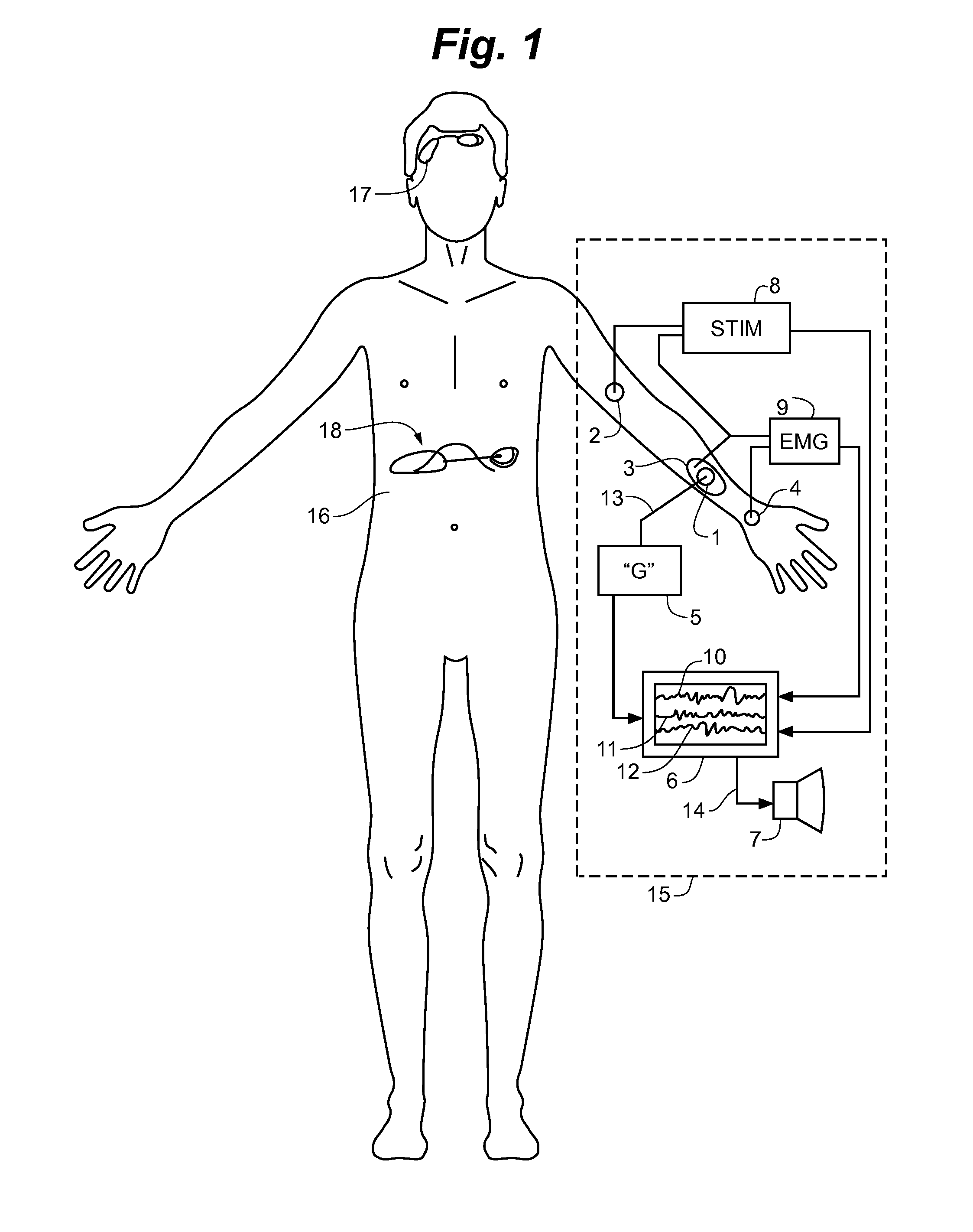 Anesthesia Monitoring Device and Method