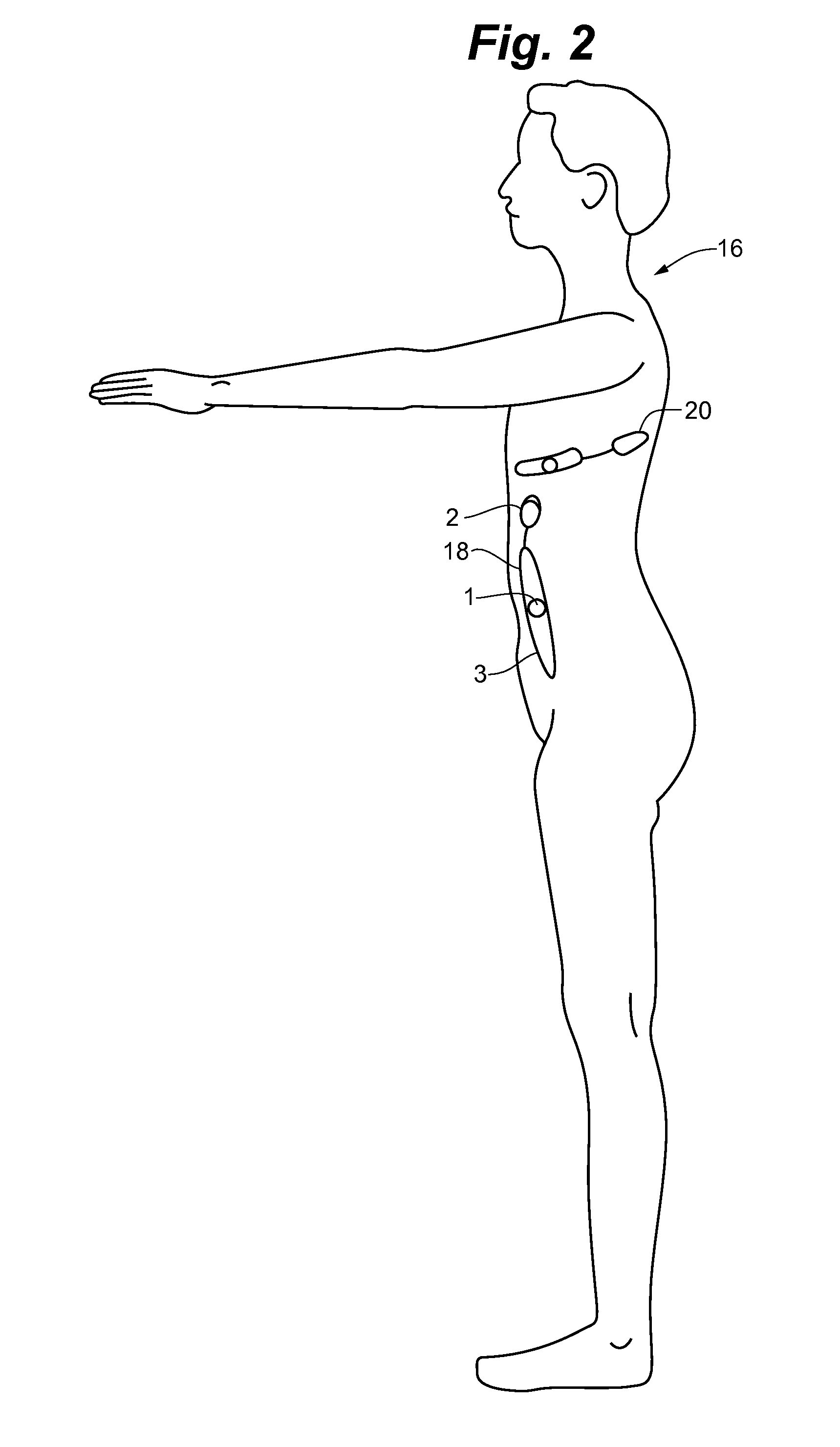 Anesthesia Monitoring Device and Method