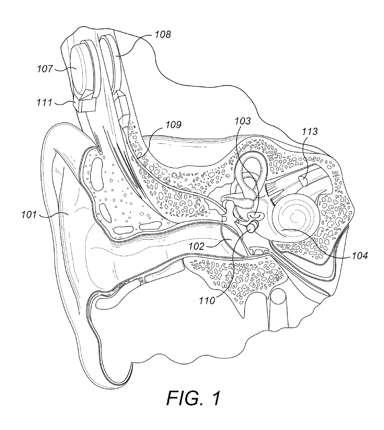 S-shaped coupling spring for middle ear implants