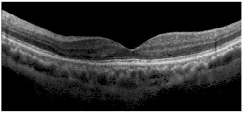 OCT fundus image semi-automatic segmentation method and device based on curve group matching