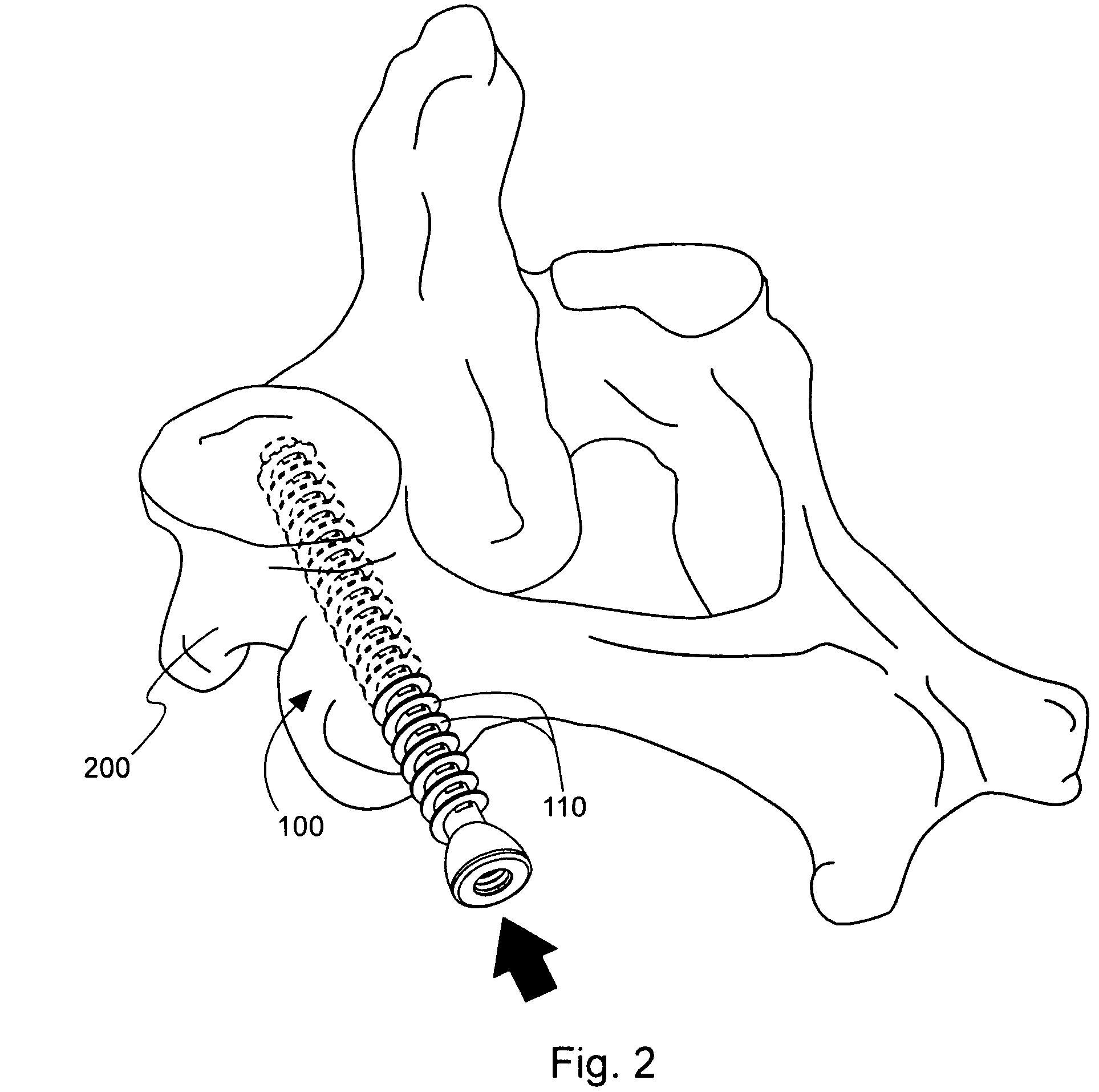 Method and device for delivering medicine to bone