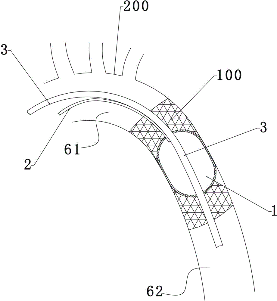 Antegrade aorta infusion tube having internal blocking function, application and usage method