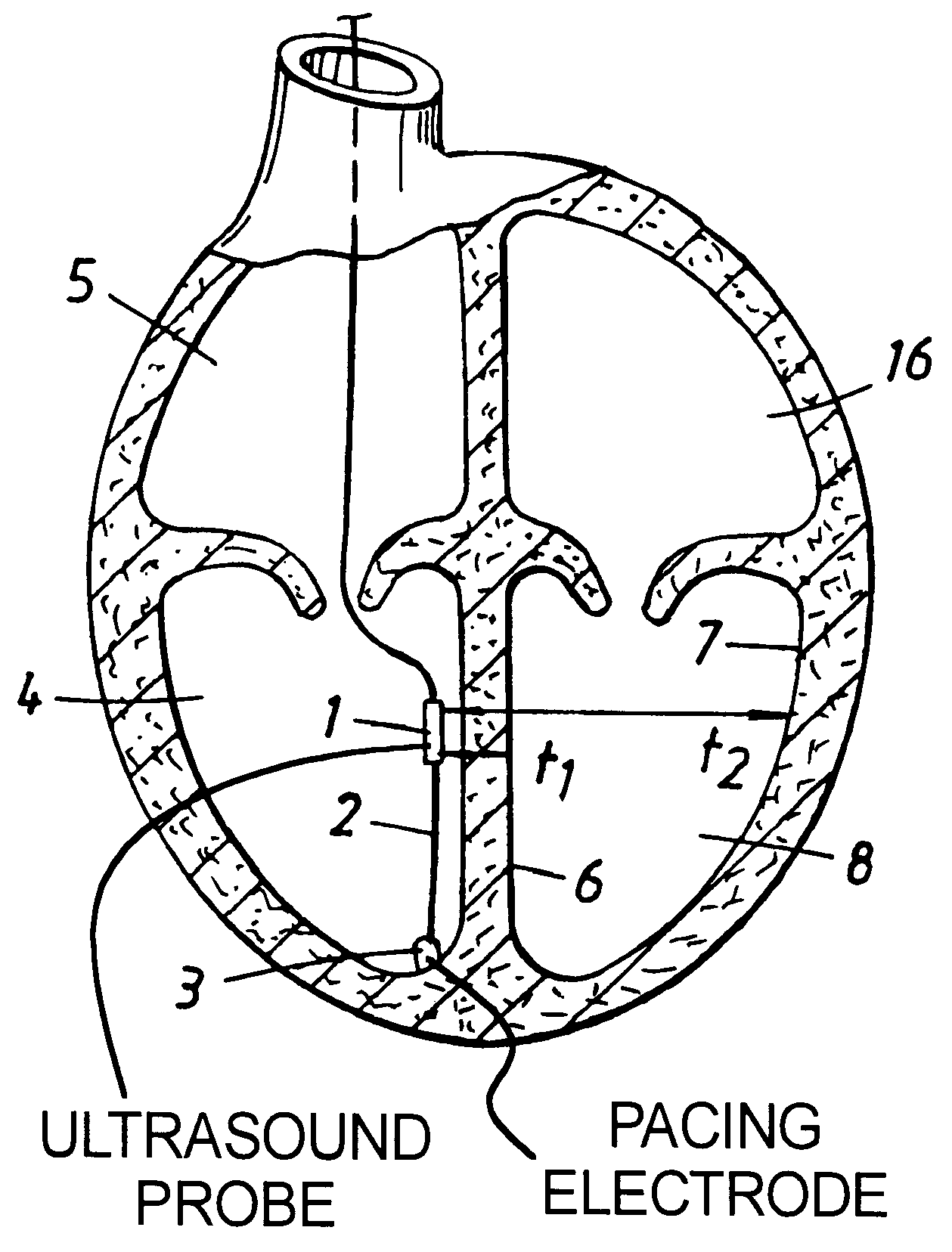 Cardiac monitoring device and a rate responsive pacemaker system