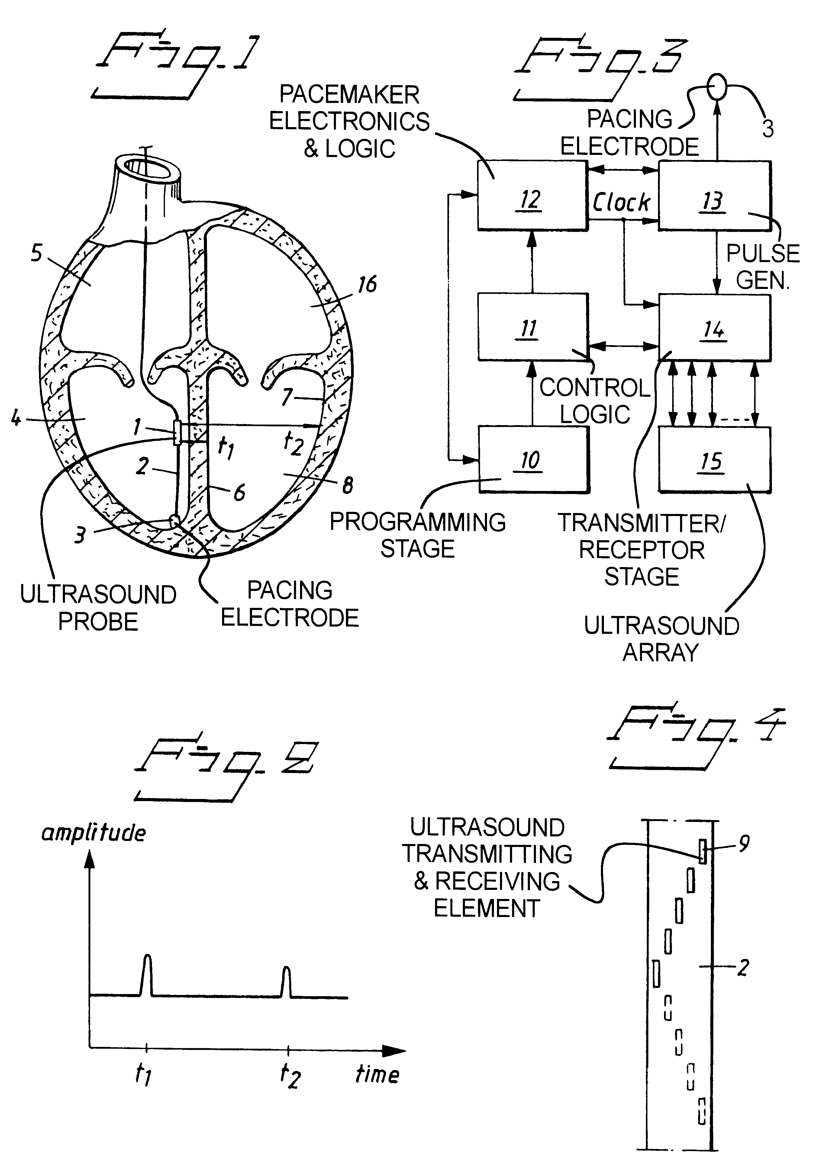 Cardiac monitoring device and a rate responsive pacemaker system