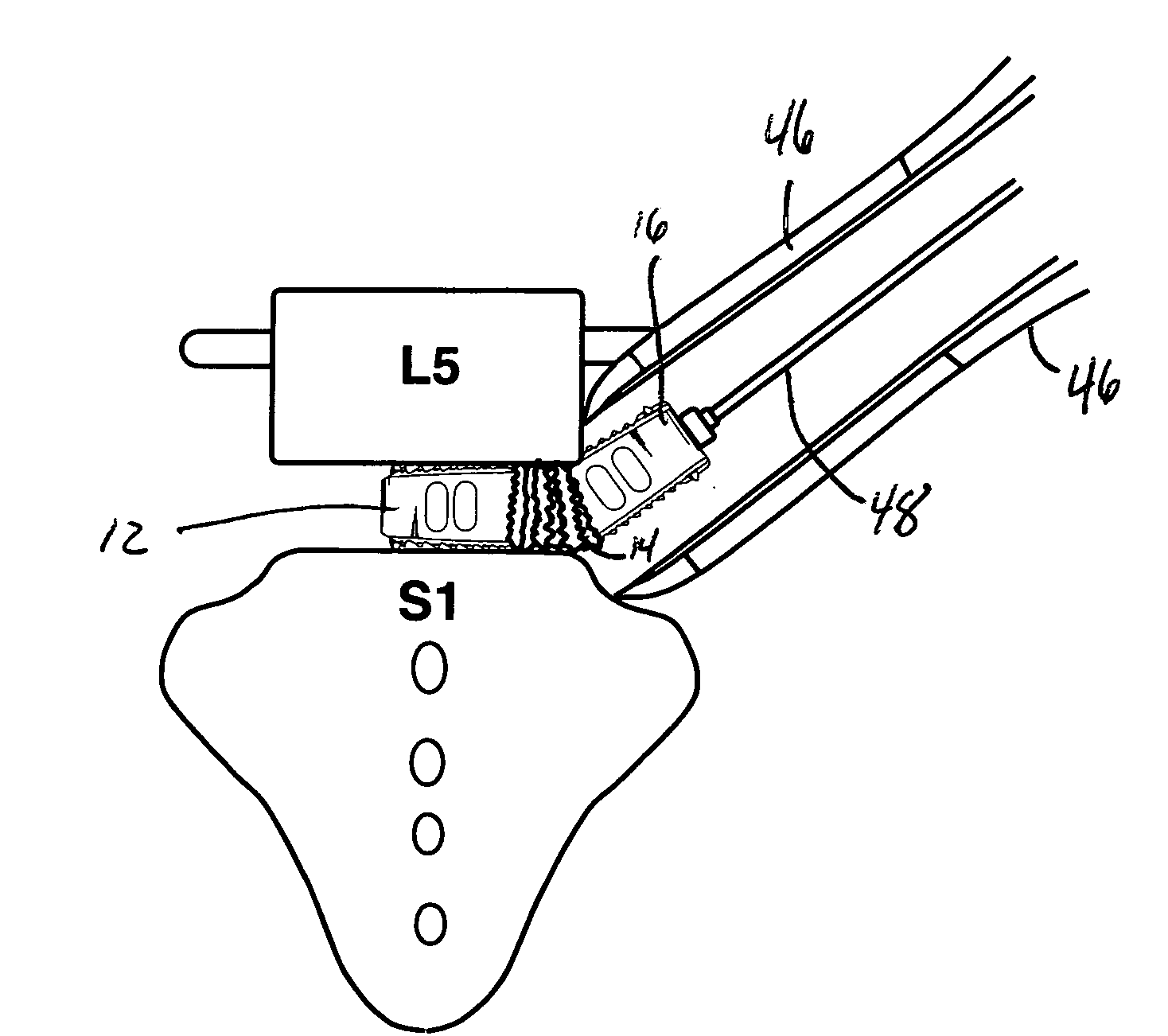 Spinal Surgical Implant and Related Methods