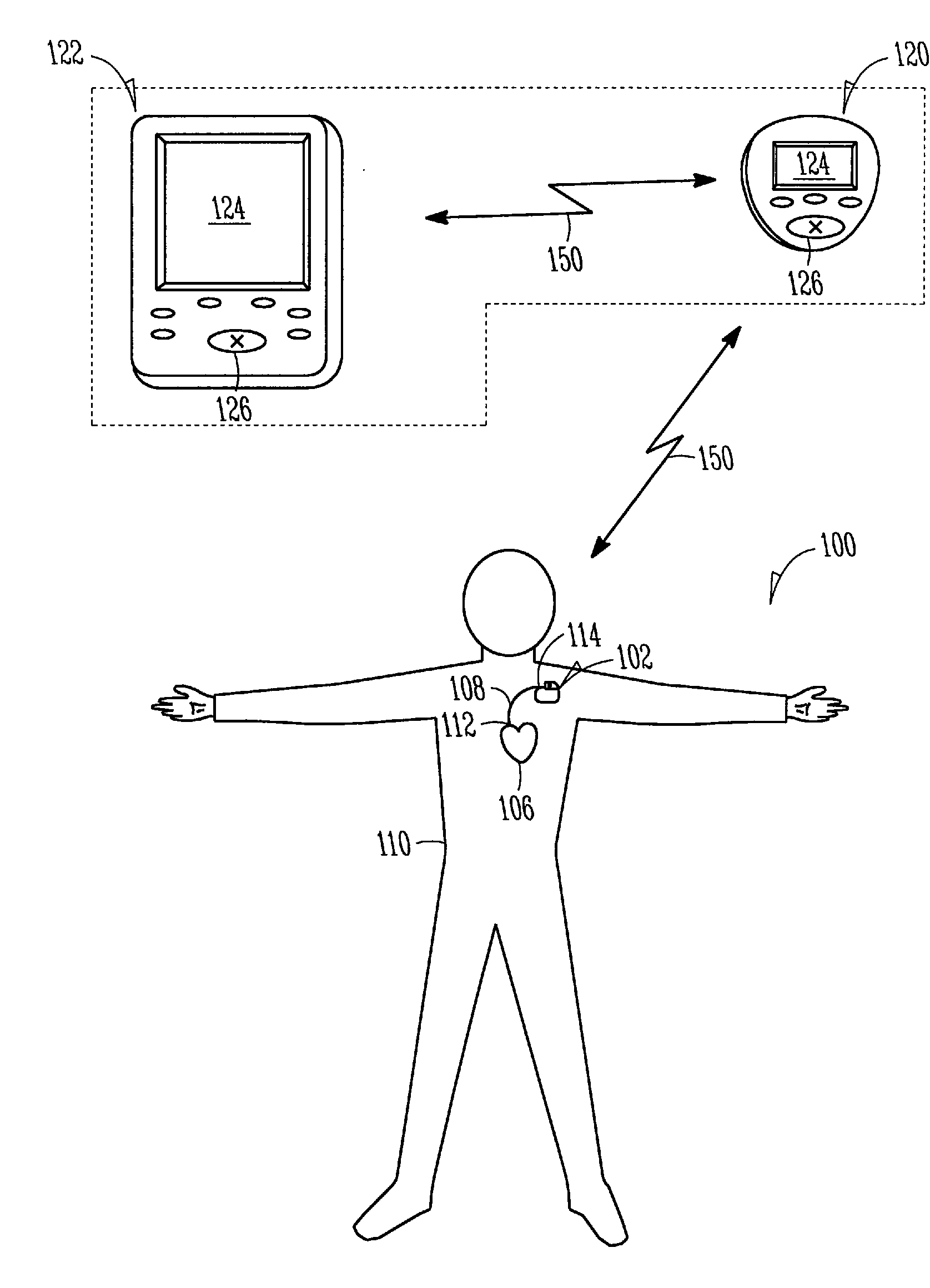 Using respiration distress manifestations for heart failure detection