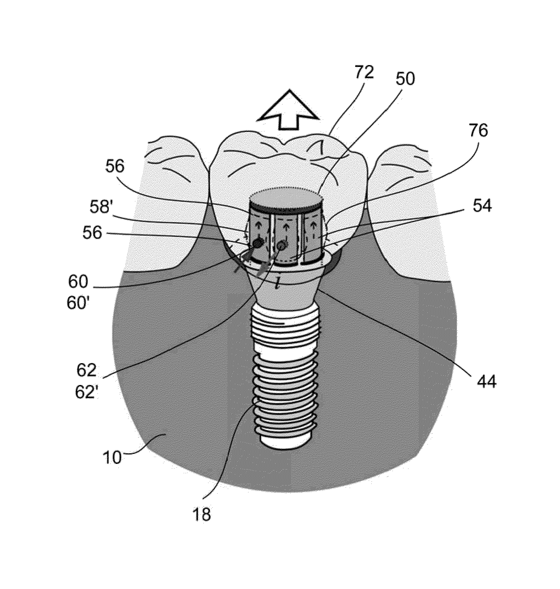 Shape memory dental retention systems