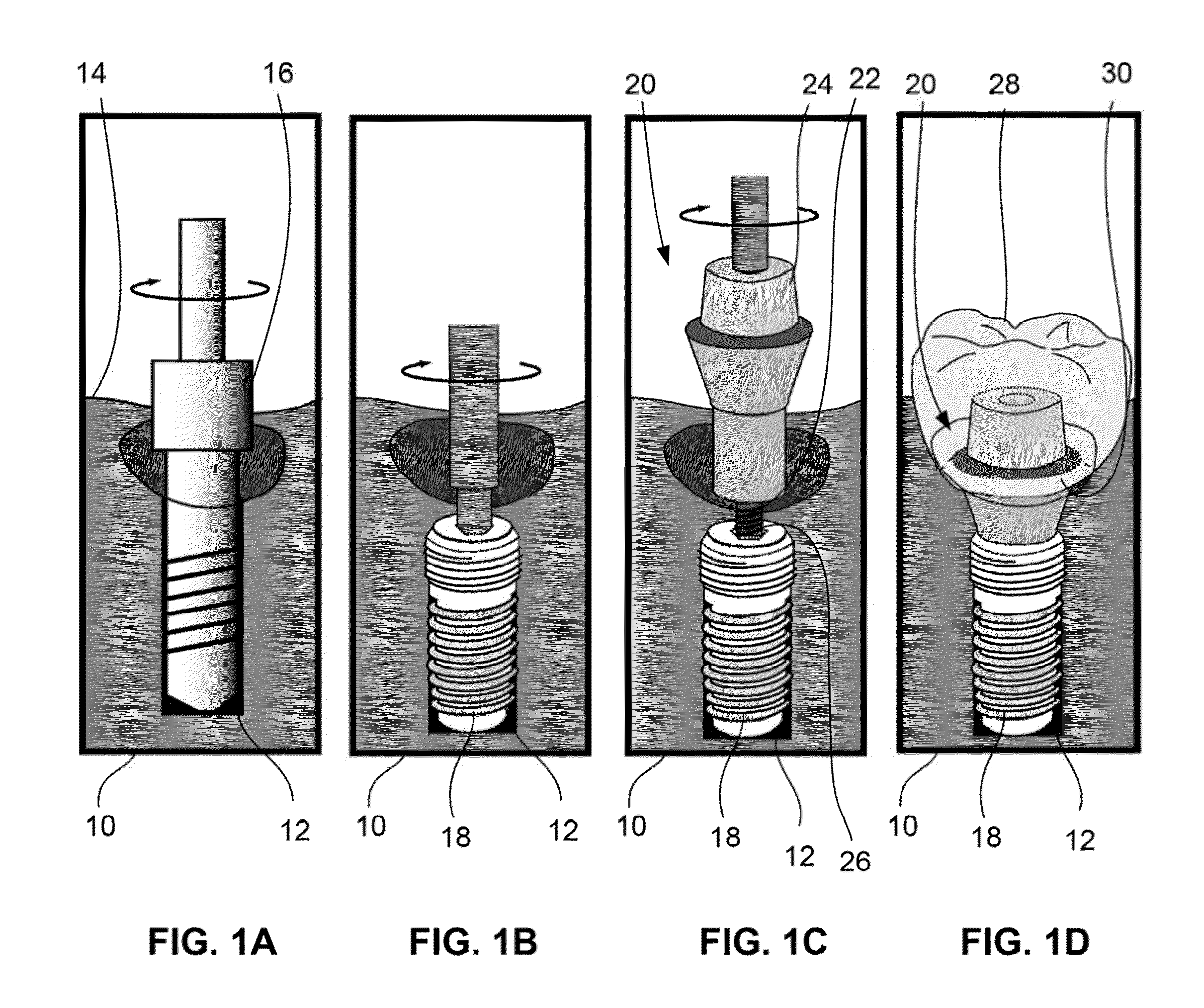 Shape memory dental retention systems