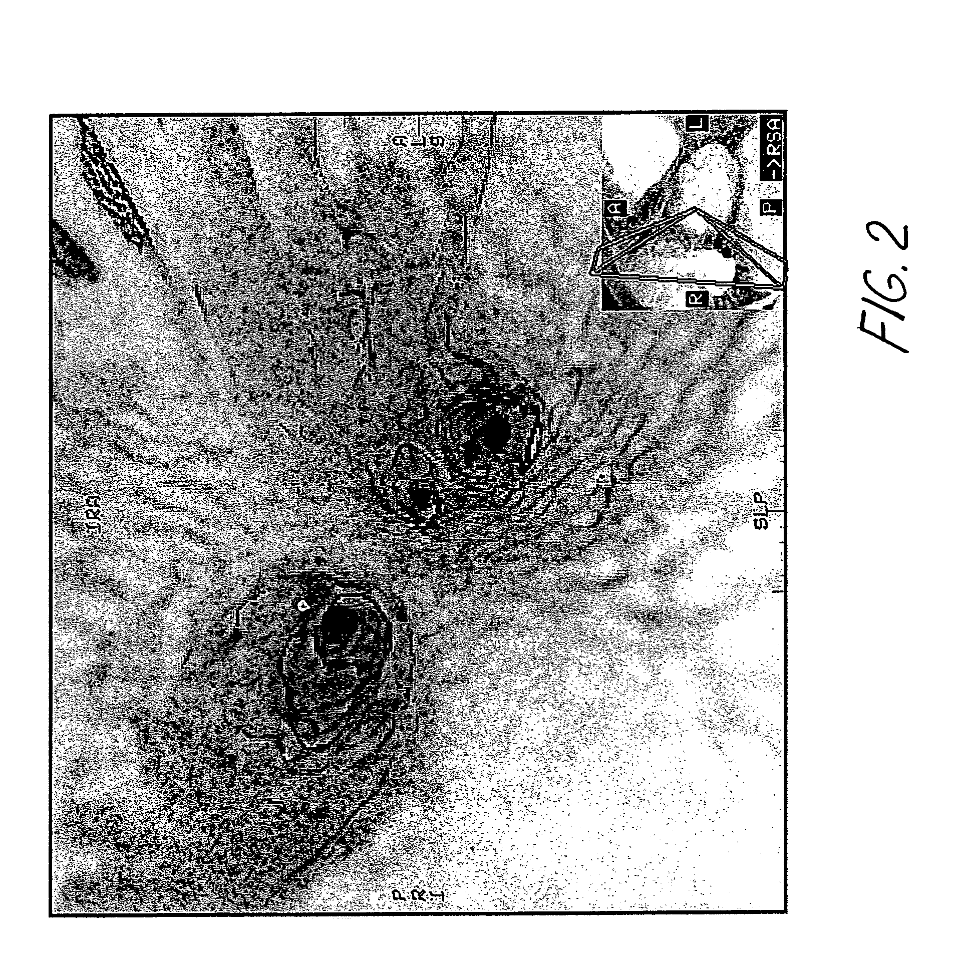 Method for pulmonary vein isolation and catheter ablation of other structures in the left atrium in atrial fibrillation