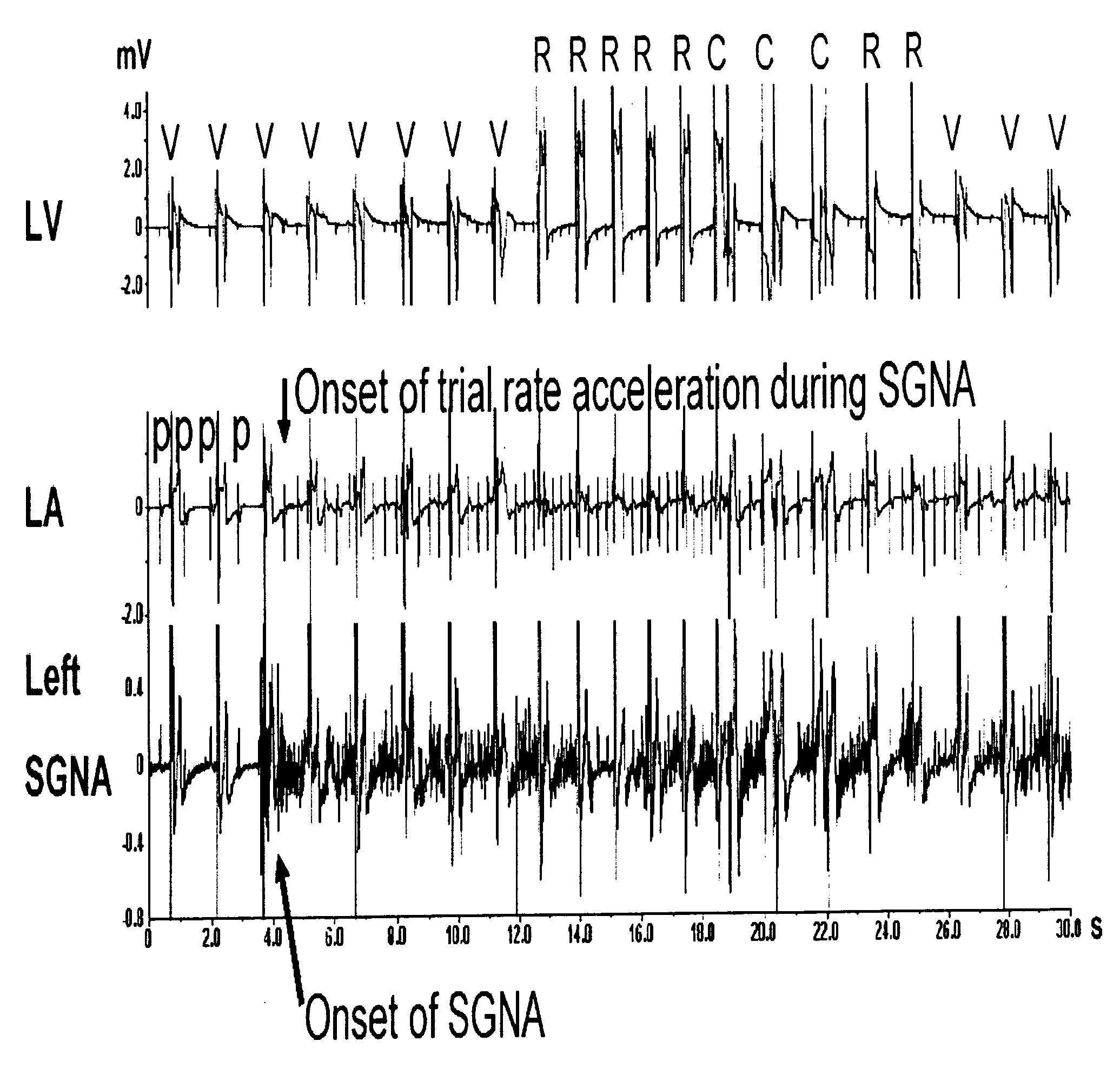 Method and system for the prediction of cardiac arrhythmias, myocardial ischemia, and other diseased condition of the heart associated with elevated sympathetic neural discharges