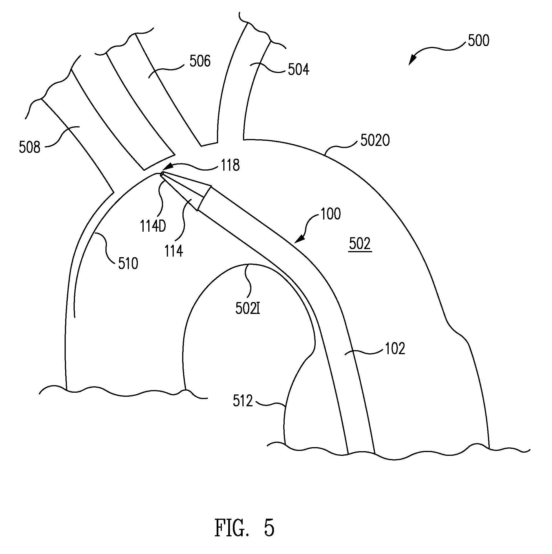 Expandable tip delivery system and method