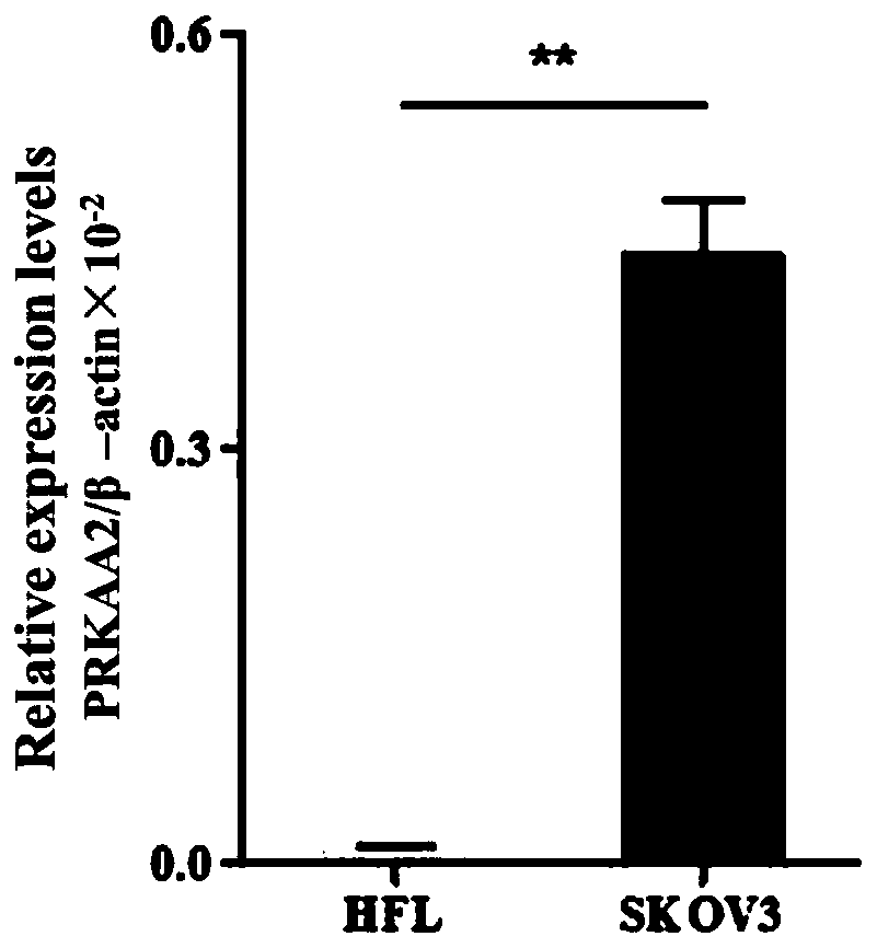 Ovarian cancer diagnosis or prognosis composition and application thereof