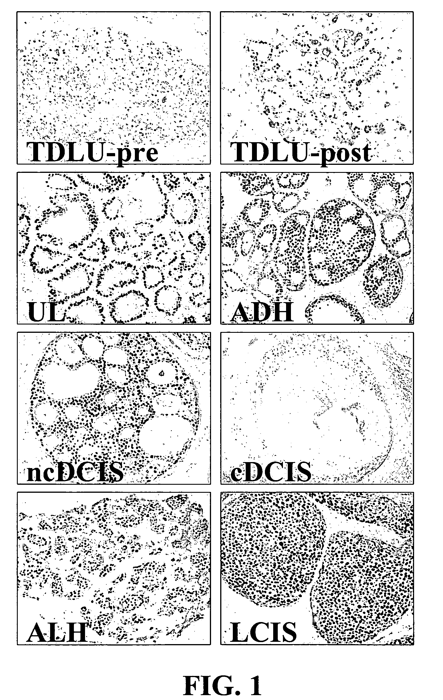 Methods and compositions in breast cancer diagnosis and therapeutics