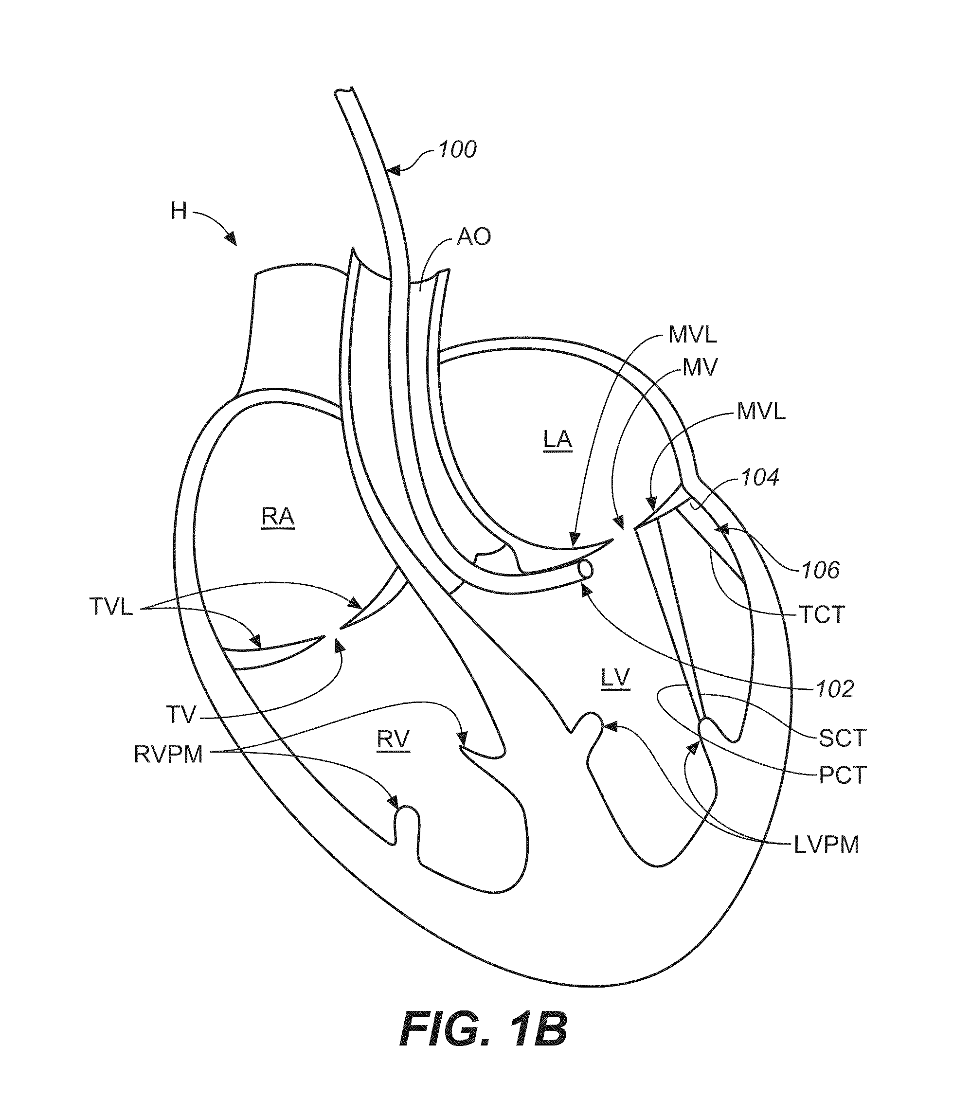 Diagnostic catheters, guide catheters, visualization devices and chord manipulation devices, and related kits and methods