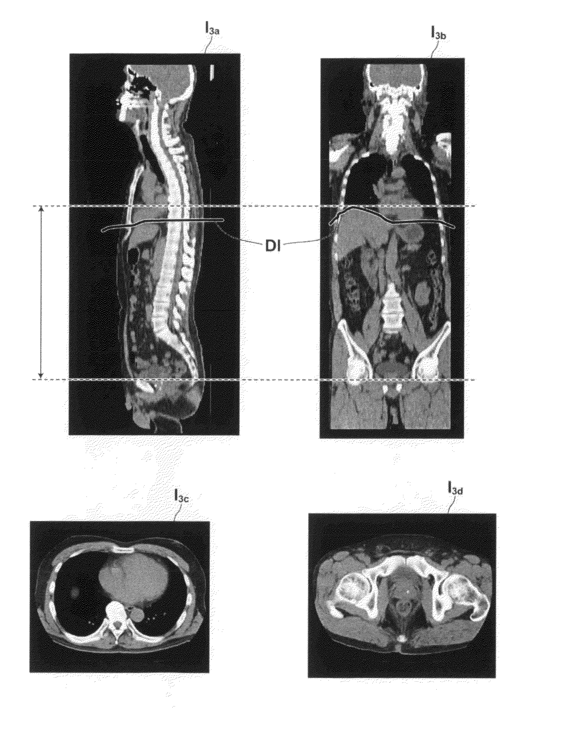 Apparatus, method, and program for detecting three dimensional abdominal cavity regions