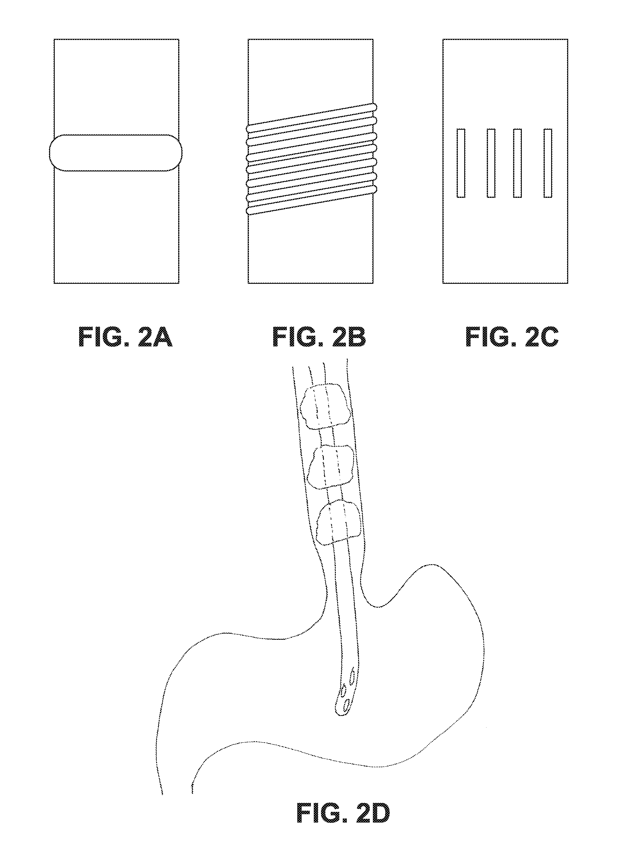 Method and device of detecting and/or blocking reflux