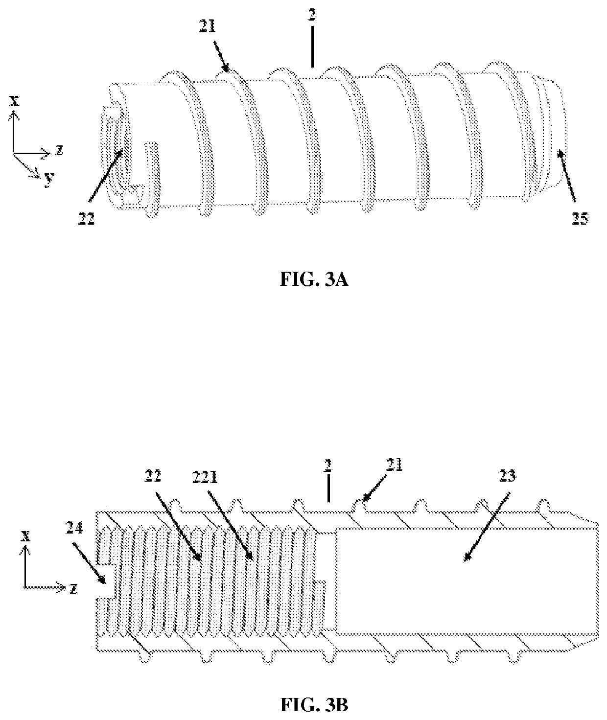 Expansible intravertebral implant system with posterior pedicle fixation