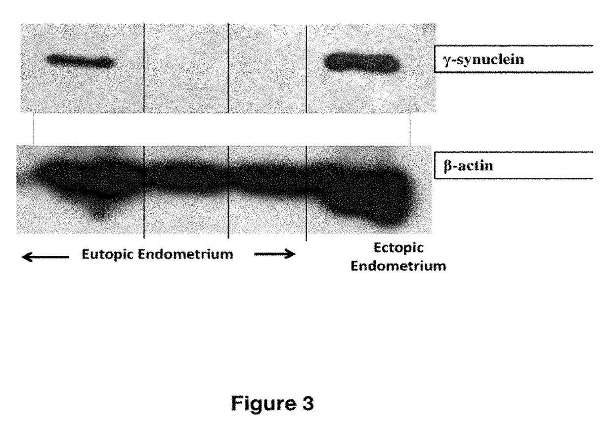 Treatment of endometriosis, angiogenesis and/or endometrial lesion growth