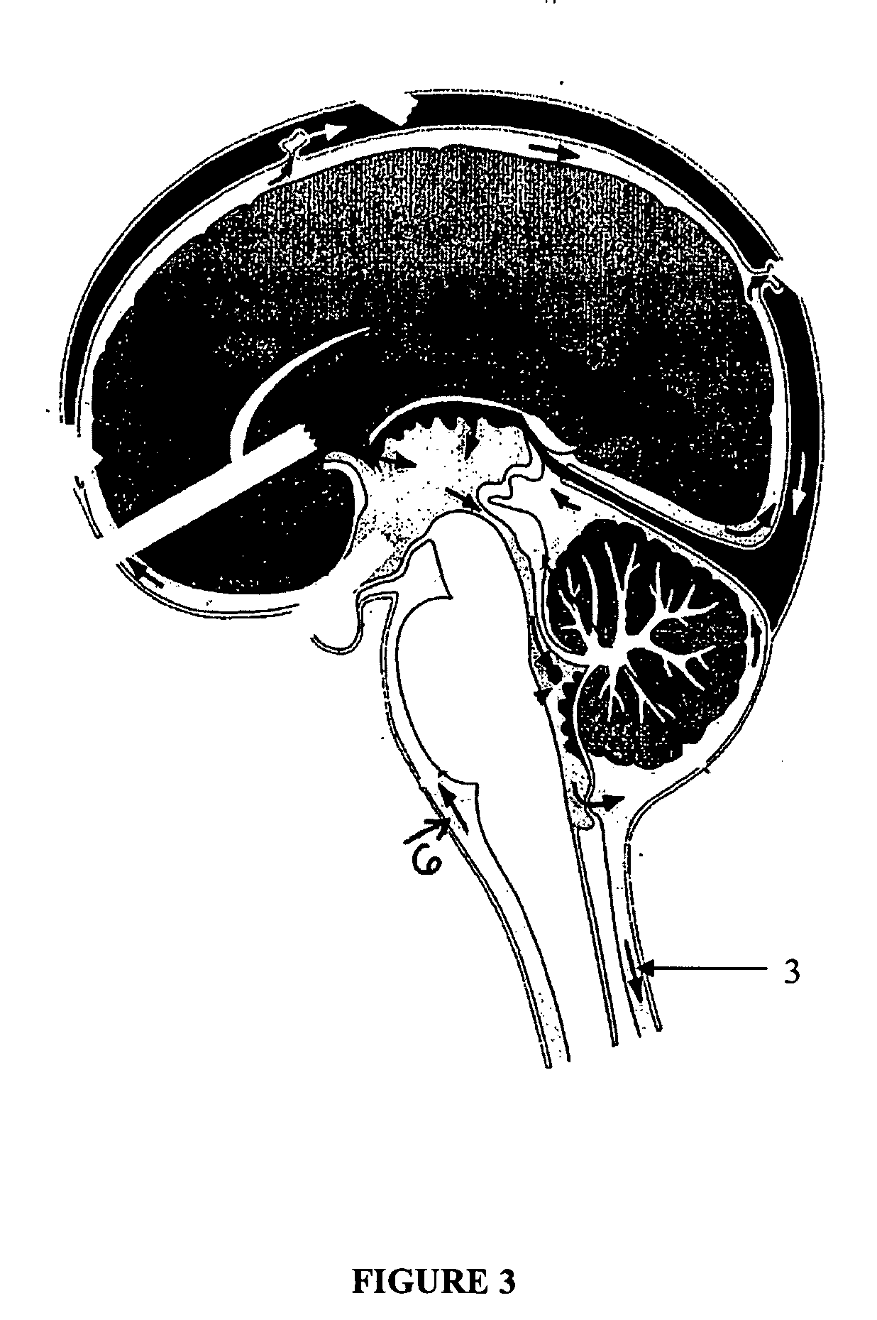 Techniques to treat neurological disorders by enhancing the presence of anti-inflammatory mediators