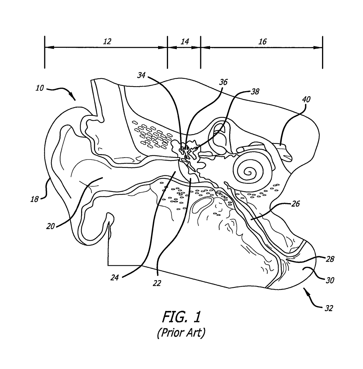 Eustachian tube dilation balloon with ventilation path